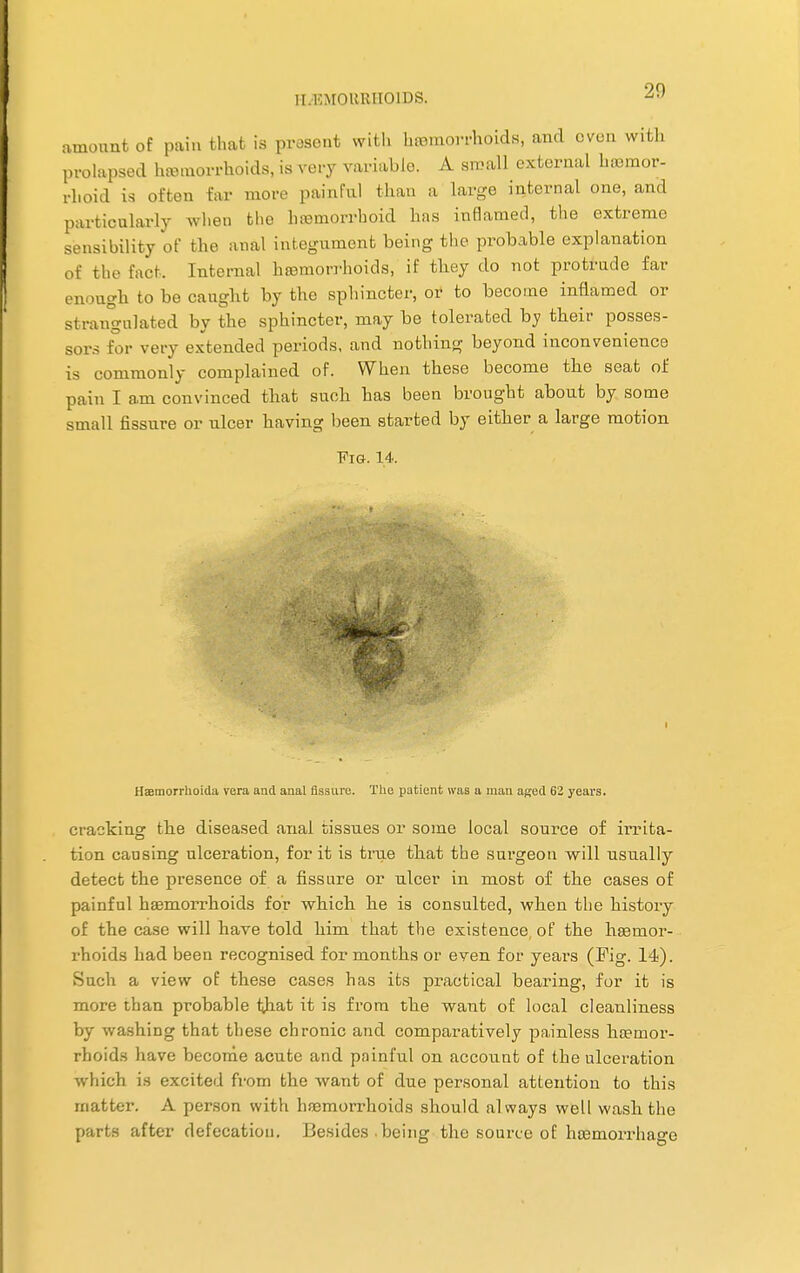 II.KMOUIUIOIDS. amount of pain that is present with hemorrhoids, and oven with prolapsed hemorrhoids, is very variable. A small external hemor- rhoid is often far more painful than a large internal one, and particularly when tho hemorrhoid has inflamed, the extreme sensibility of the anal integument being the probable explanation of the tact. Internal haemorrhoids, if they do not protrude far enough to be caught by the sphincter, or to become inflamed or strangulated by the sphincter, may be tolerated by their posses- tor very extended periods, and nothing beyond inconvenience is commonly complained of. When these become the seat of pain I am convinced that such has been brought about by some small fissure or ulcer having been started by either a large motion VlGr. 14. Haemorrhoida vera and anal Assure. The patient was a man aged 62 years. cracking the diseased anal tissues or some local source of irrita- tion causing ulceration, for it is true that the surgeon will usually detect the presence of a fissure or ulcer in most of the cases of painful hemorrhoids for which he is consulted, when the history of the case will have told him that the existence of the haemor- rhoids had been recognised for months or even for years (Fig. 14). Such a view of these cases has its practical bearing, for it is more than probable tjiat it is from the want of local cleanliness by washing that these chronic and comparatively painless hemor- rhoids have become acute and painful on account of the ulceration which is excited from the want of due personal attention to this matter. A person with hemorrhoids should always well wash the parts after defecation. Besides .being the source of hemorrhage