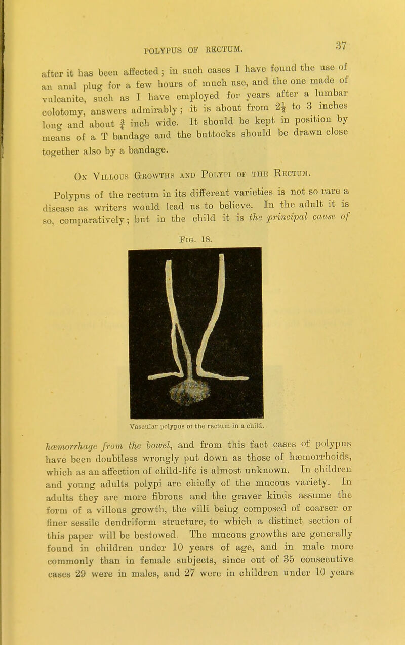 after it has been affected; in such cases I have found the use o anal plug for a few hours of much use, and the one made of vulcanite, such as I have employed for years after a lumbar colotomy, answers admirably ; it is about from 2* to 3 inches long and about f inch wide. It should be kept in position by means of a T bandage and the buttocks should be drawn close together also by a bandage. Ox Villous Growths and Polypi of the Rectum. Polypus of the rectum in its different varieties is not so rare a disease as writers would lead us to believe. In the adult it is so, comparatively; but in the child it is the principal cause of Fig. 18. Vascular polypus of the rectum in a child. kcemorrhage from the bowel, and from this fact cases of polypus have been doubtless wrongly put down as those of haemorrhoids, which as an affection of child-life is almost unknown. In children and young adults polypi are ckiofry of the mucous variety. In adults they are more fibrous and the graver kinds assume the form of a villous growth, the villi beiug composed of coarser or finer sessile dendriform structure, to which a distinct section of this paper will be bestowed. The mucous growths are generally found in children under 10 years of age, and in male more commonly than in female subjects, since out of 35 consecutive cases 29 were in males, and 27 were in children under 1U years