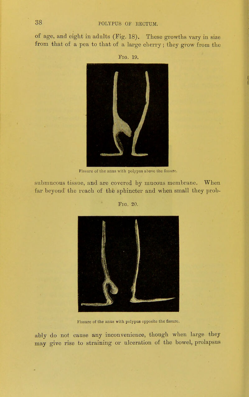 of age, and eight in adults (Fig. 18). These growths vary in size from that of a pea to that of a large cherry; they grow from the Fig. 19. Fissure of the anus with polypus above the Assure. submucous tissue, and are covered by mucous membrane. When far beyoud' the reach of the sphincter and when small they prob- Fig. 20. Fissure of the anus with polypus opposite the fissure. ably do not cause any inconvenience, though when large they may give rise to straining or ulceration of the bowel, prolapsus