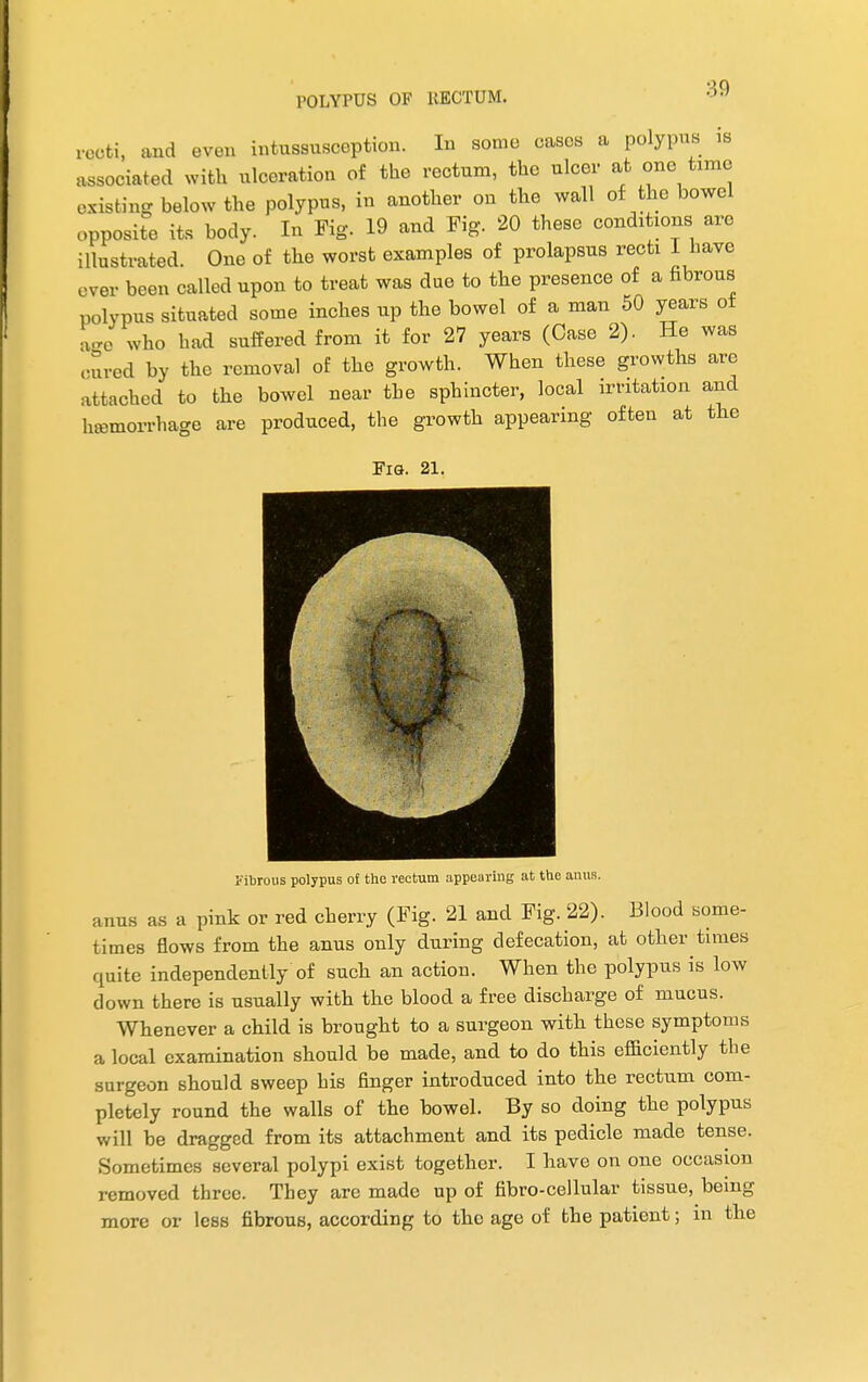 recti, and even intussusception. In some cases a polypus is associated with ulceration of the rectum, the ulcer at one tame existing below the polypus, in another on the wall of the bowel opposite its body. In Fig. 19 and Fig. 20 these conditions are illustrated. One of the worst examples of prolapsus recti I have ever been called upon to treat was due to the presence of a fibrous polypus situated some inches up the bowel of a man 50 years ot ace who had suffered from it for 27 years (Case 2). He was <mred by the removal of the growth. When these growths are attached to the bowel near the sphincter, local irritation and heemorrhage are produced, the growth appearing often at the Fig. 21. Fibrous polypus of the rectum appearing at the anus. anus as a pink or red cherry (Fig. 21 and Fig. 22). Blood some- times flows from the anus only during defecation, at other times quite independently of such an action. When the polypus is low down there is usually with the blood a free discharge of mucus. Whenever a child is brought to a surgeon with these symptoms a local examination should be made, and to do this efficiently the surgeon should sweep his finger introduced into the rectum com- pletely round the walls of the bowel. By so doing the polypus will be dragged from its attachment and its pedicle made tense. Sometimes several polypi exist together. I have on one occasion removed three. They are made up of fibro-cellular tissue, being more or less fibrous, according to the age of the patient; in the