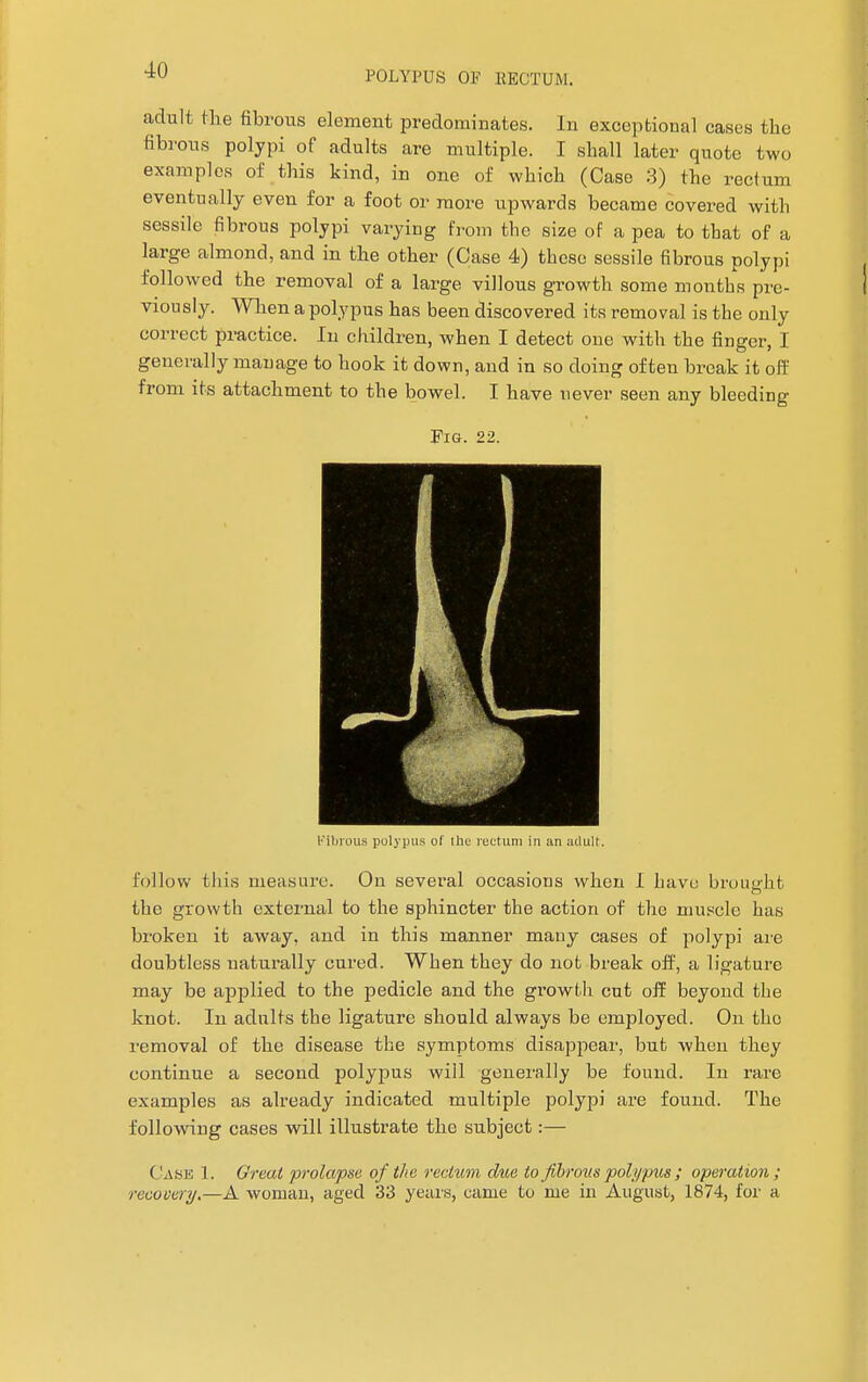 adult the fibrous element predominates. In exceptional cases the fibrous polypi of adults are multiple. I shall later quote two examples of this kind, in one of which (Case 3) the rectum eventually even for a foot or more upwards became covered with sessile fibrous polypi varying from the size of a pea to that of a large almond, and in the other (Case 4) these sessile fibrous polypi followed the removal of a large villous growth some months pre- viously. When a polypus has been discovered its removal is the only correct practice. In children, when I detect one with the finger, I generally manage to hook it down, and in so doing often break it off from its attachment to the bowel. I have never seen any bleeding Fig. 22. Fibrous polypus of the rectum in an adult, follow this measure. On several occasions when I have brought o the growth external to the sphincter the action of the muscle has broken it away, and in this manner many cases of polypi are doubtless naturally cured. When they do not break off, a ligature may be applied to the pedicle and the growth cut off beyond the knot. In adults the ligature should always be employed. On the removal of the disease the symptoms disappear, but when they continue a second polypus will generally be found. In rare examples as already indicated multiple polypi are found. The following cases will illustrate the subject:— Case 1. Great prolapse of the rectum due to fibrous polypus ; operation; recovery.—A woman, aged 33 years, came to me in August, 1874, for a