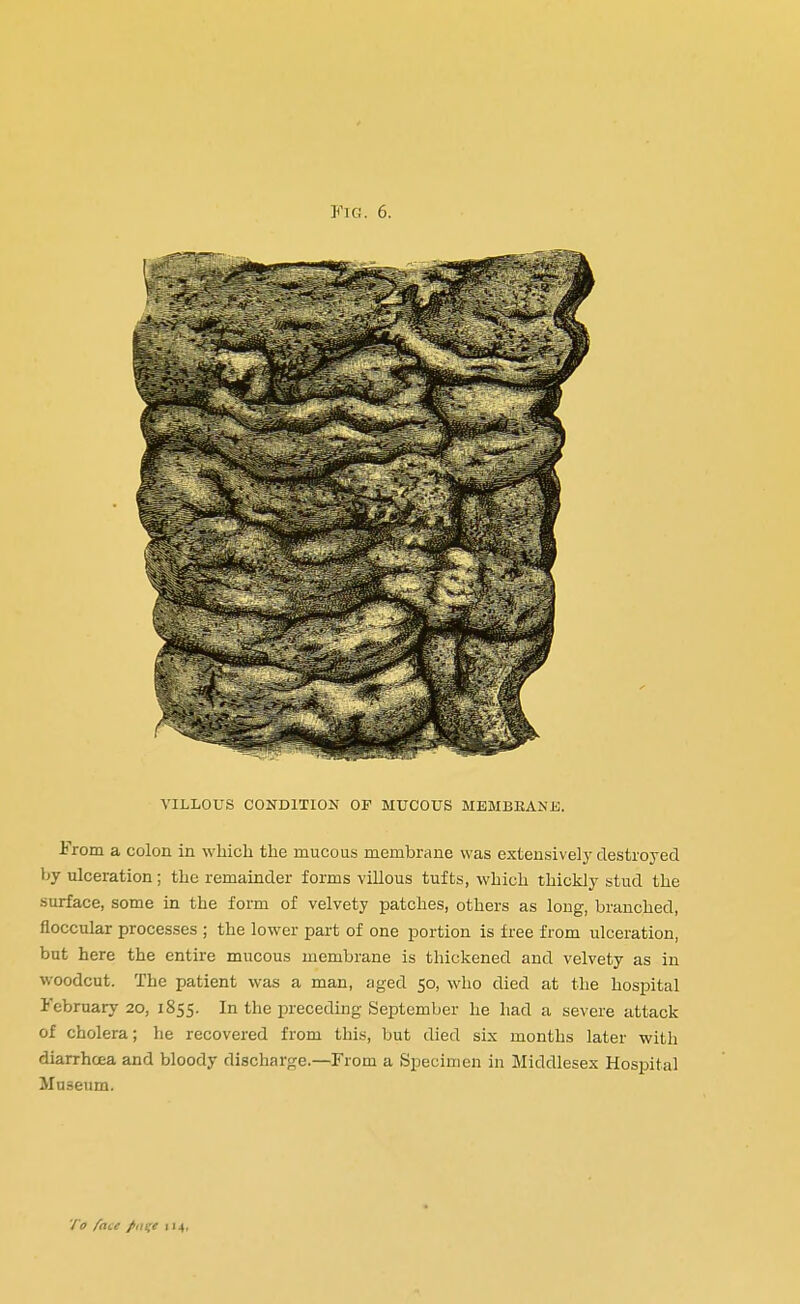 VILLOUS CONDITION OF MUCOUS MEMBBANE. From a colon in which the mucous membrane was extensive!}- destroyed by ulceration; the remainder forms villous tufts, which thickly stud the surface, some in the form of velvety patches, others as long, branched, floccular processes ; the lower part of one portion is free from ulceration, but here the entire mucous membrane is thickened and velvety as in woodcut. The patient was a man, aged 50, who died at the hospital February 20, 1855. In the preceding September he had a severe attack of cholera; lie recovered from this, but died six months later with diarrhoea and bloody discharge.—From a Specimen in Middlesex Hospital Museum.