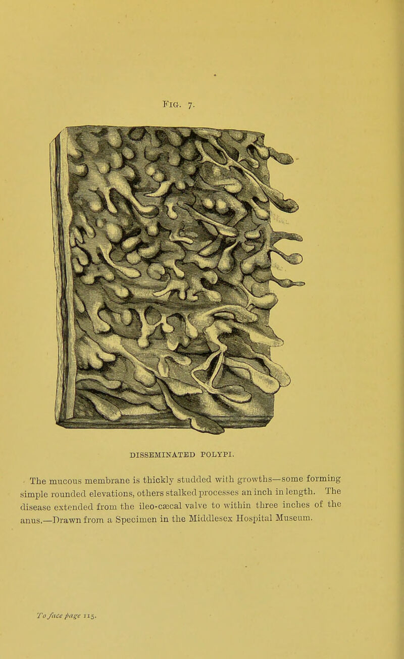 DISSEMINATED POLYPI. The mucous membrane is thickly studded with growths—some forming simple rounded elevations, others stalked processes an inch in length. The disease extended from the ileo-caical valve to within three inches of the anus.—Drawn from a Specimen in the Middlesex Hospital Museum.