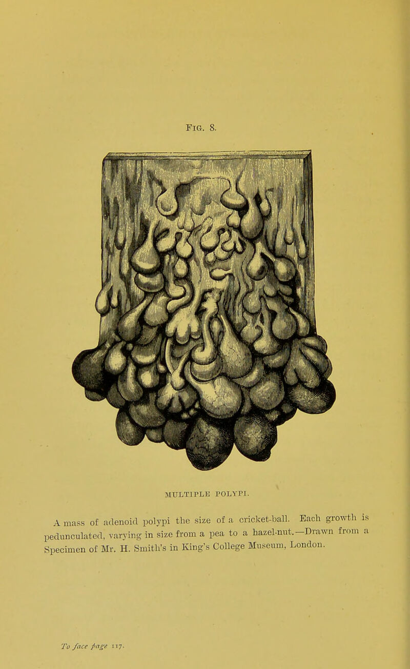 Fm. S. MULTIPLE POLYPI. A mass of adenoid polypi the size of a cricket-ball. Each growth pedunculated, varying in size from a pea to a hazel-nut.-Drawn from Specimen of Mr. H. Smith's in King's College Museum, London.
