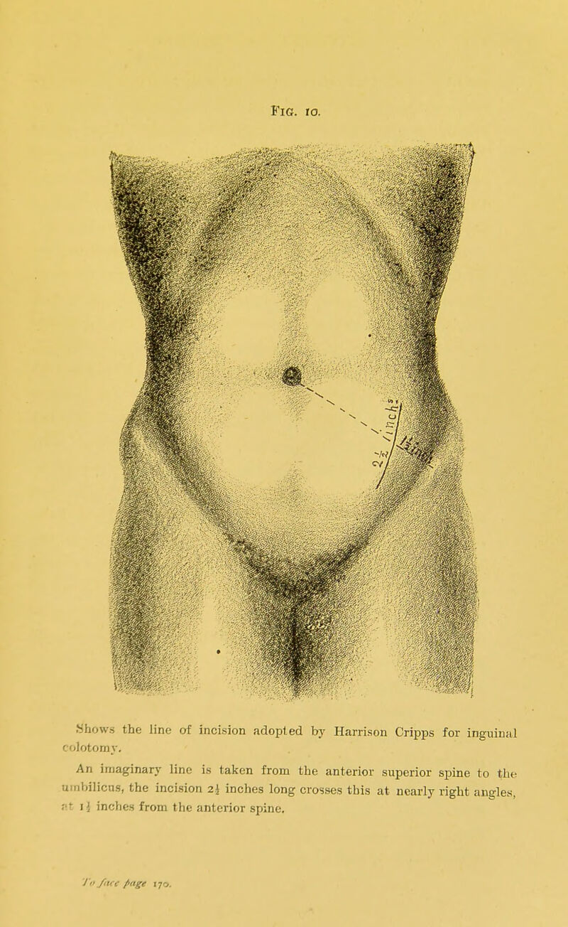 Shows the line of incision adopted by Harrison Cripps for inguinal colotomy. An imaginary line is taken from the anterior superior spine to the umbilicus, the incision 2j inches long crosses this at nearly right angles, pt ij inches from the anterior spine. To fact page i jo.
