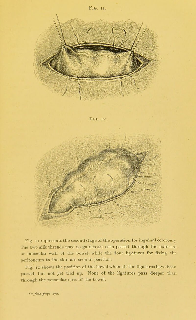 Fig. 11 represents the second stage of the operation for inguinal colotomy. The two silk threads used as guides are seen passed through the external or muscular wall of the bowel, while the four ligatures for fixing the peritoneum to the skin are seen in position. Fig. 12 shows the position of the bowel when all the ligatures have been passed, but not yet tied up. None of the ligatures pass deeper than rhrough the muscular coat of the bowel.