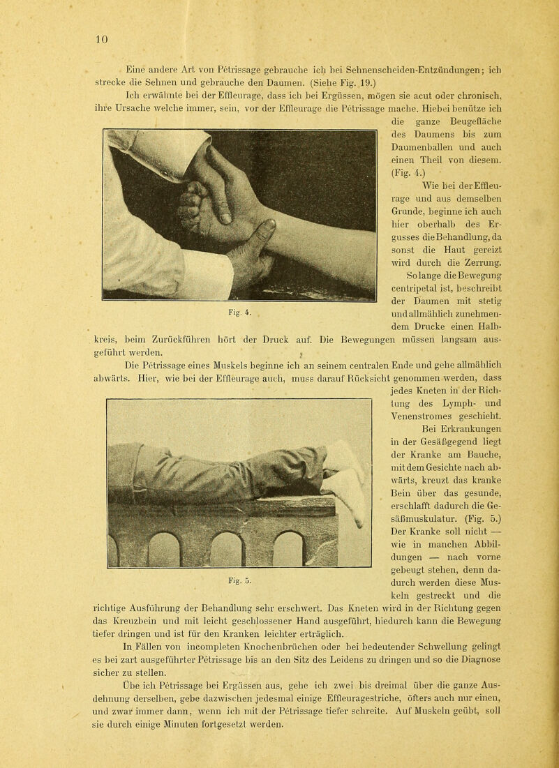 Eine andere Art von Petrissage gebrauche ich bei Sehnenscheiden-Entzündungen; ich strecke die Sehnen und gebrauche den Daumen. (Siehe Fig. 19.) Ich erwähnte bei der Effleurage, dass ich bei Ergüssen, mögen sie acut oder chronisch, ihre Ursache welche immer, sein, vor der Effleurage die Petrissage mache. Hiebei benütze ich die ganze Beugefläche des Daumens bis zum Daumenballen und auch einen Theil von diesem. (Fig. 4.) Wie bei der Effleu- rage und aus demselben Grunde, beginne ich auch hier oberhalb des Er- gusses die Behandlung, da sonst die Haut gereizt wird durch die Zerrung. Solange die Bewegung centripetal ist, beschreibt der Daumen mit stetig und allmählich zunehmen- dem Drucke einen Halb- kreis, beim Zurückführen hört der Druck auf. Die Bewegungen müssen langsam aus- geführt werden. ? Die Petrissage eines Muskels beginne ich an seinem centralen Ende und gehe allmählich abwärts. Hier, wie bei der Effleurage auch, muss darauf Rücksicht genommen werden, dass jedes Kneten in der Rich- tung des Lymph- und Venenstromes geschieht. Bei Erkrankungen in der Gesäßgegend liegt der Kranke am Bauche, mit dem Gesichte nach ab- wärts, kreuzt das kranke Bein über das gesunde, erschlafft dadurch die Ge- säßmuskulatur. (Fig. 5.) Der Kranke soll nicht — wie in manchen Abbil- dungen — nach vorne gebeugt stehen, denn da- durch werden diese Mus- keln gestreckt und die richtige Ausführung der Behandlung sehr erschwert. Das Kneten wird in der Richtung gegen das Kreuzbein und mit leicht geschlossener Hand ausgeführt, hiedurch kann die Bewegung tiefer dringen und ist für den Kranken leichter erträglich. In Fällen von incompleten Knochenbrüchen oder bei bedeutender Schwellung gelingt es bei zart ausgeführter Petrissage bis an den Sitz des Leidens zu dringen und so die Diagnose sicher zu stellen. Übe ich Petrissage bei Ergüssen aus, gehe ich zwei bis dreimal über die ganze Aus- dehnung derselben, gebe dazwischen jedesmal einige Effleuragestriche, öfters auch nur einen, und zwai'immer dann, wenn ich mit der Petrissage tiefer schreite. Auf Muskeln geübt, soll sie durch einige Minuten fortgesetzt werden.