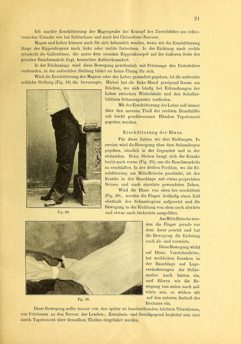 Ich machte Erschütterung der Magengrube bei Krampf des Zwerchfelles aus reflec- torischer Ursache wie bei Schluchzen und auch bei Chloroform-Narcose. Magen und Leber können auch für sich behandelt werden, wenn wir die Erschütterung längs des Rippenbogens nach links oder rechts fortsetzen. In der Richtung nach rechts erheischt die Gallenblase, die unter dem neunten Rippenknorpel auf der äußeren Seite des geraden Bauchmuskels liegt, besondere Aufmerksamkeit. In der Rückenlage wird diese Bewegung gewöhnlich mit Petrissage des Unterleibes verbunden, in der aufrechten Stellung bildet sie keine Übung für sich. Wird die Erschütterung des Magens oder der Leber gesondert gegeben, ist die aufrechte seitliche Stellung (Fig. 16) die bevorzugte. Hiebei hat die linke Hand genügend Raum am Rücken, wo sich häufig bei Erkrankungen der Leber zwischen Wirbelsäule und den Schulter- blättern Schmerzpunkte vorfinden. Mit der Erschütterung der Leber soll immer über den unteren Theil der rechten Brusthälfte mit leicht geschlossenen Händen Tapotement gegeben werden. Erschütterung der Blase. Für diese haben wir drei Stellungen. In zweien wird die Bewegung über dem Schambogen gegeben, nämlich in der liegenden^ und in der stehenden. Beim Stehen beugt sich der Kranke leicht nach vorne (Fig. 29), um die Bauchmuskeln zu erschlaffen. In der dritten Position, wo die Er- schütterung am Mittelfleische geschieht, ist der Kranke in der Bauchlage mit etwas gespreizten Beinen und nach einwärts gewendeten Zehen. Wird die Blase von oben her erschüttert (Fig. 30), werden die Finger beiläufig einen Zoll oberhalb des Schambogens aufgesetzt und die Bewegung in der Richtung von oben nach abwärts und etwas nach rückwärts ausgeführt. Am Mittelfleische wer- den die Finger gerade vor dem Anus gesetzt und bat die Bewegung die Richtung nach ab- und vorwärts. Diese Bewegung wirkt auf Blase, Vorsteherdrüse, bei weiblichen Kranken in der Bauchlage auf Lage- veränderungen der Gebär- mutter nach hinten ein, und führen wir die Be- wegung von unten nach auf- wärts aus, so wirken wir auf den unteren Antheil des Rectums ein. Diese Bewegung sollte immer von den später zu beschreibenden leichten Vibrationen, von Frictionen an den Nerven' der Lenden-, Kreuzbein- und Gesäßgegend begleitet sein und durch Tapotement über denselben Theilen eingeleitet weiden.