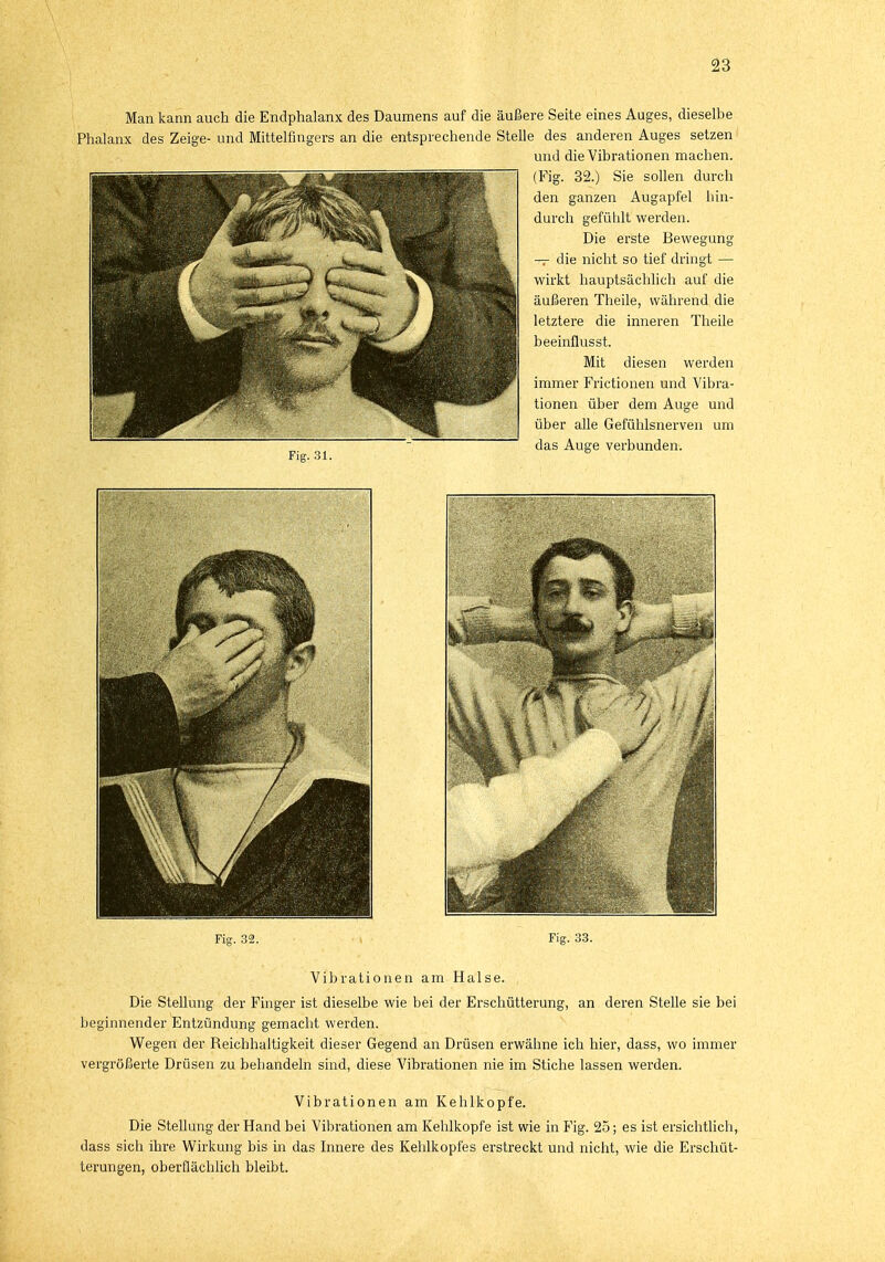 Man kann auch die Endphalanx des Daumens auf die äußere Seite eines Auges, dieselbe Phalanx des Zeige- und Mittelfingers an die entsprechende Stelle des anderen Auges setzen und die Vibrationen machen. (Fig. 32.) Sie sollen durch den ganzen Augapfel hin- durch gefühlt werden. Die erste Bewegung — die nicht so tief dringt — wirkt hauptsächlich auf die äußeren Theile, während die letztere die inneren Theile beeinflusst. Mit diesen werden immer Frictionen und Vibra- tionen über dem Auge und über alle Gefühlsnerven um das Auge verbunden. Fig. 31. ö Fig. 32. Fig. 33. Vibrationen am Halse. Die Stellung der Finger ist dieselbe wie bei der Erschütterung, an deren Stelle sie bei beginnender Entzündung gemacht werden. Wegen der Reichhaltigkeit dieser Gegend an Drüsen erwähne ich hier, dass, wo immer vergrößerte Drüsen zu behandeln sind, diese Vibrationen nie im Stiche lassen werden. Vibrationen am Kehlkopfe. Die Stellung der Hand bei Vibrationen am Kehlkopfe ist wie in Fig. 25; es ist ersichtlich, dass sich ihre Wirkung bis in das Innere des Kehlkopfes erstreckt und nicht, wie die Erschüt- terungen, oberflächlich bleibt.