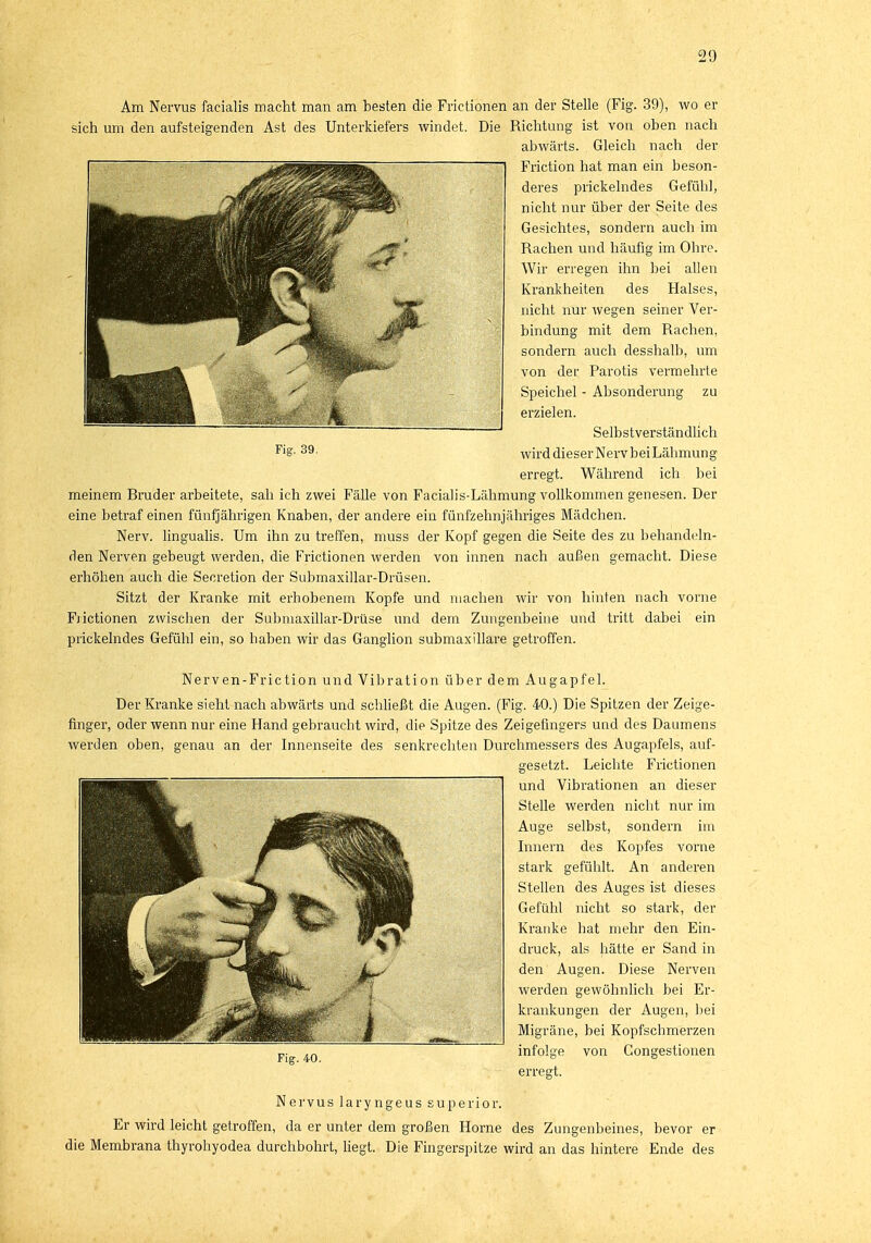 Am Nervus facialis macht man am besten die Frictionen an der Stelle (Fig. 39), wo ei- sten um den aufsteigenden Ast des Unterkiefers windet. Die Richtung ist von oben nach abwärts. Gleich nach der Friction hat man ein beson- deres prickelndes Gefühl, nicht nur über der Seite des Gesichtes, sondern auch im Rachen und häufig im Ohre. Wir erregen ihn bei allen Krankheiten des Halses, nicht nur wegen seiner Ver- bindung mit dem Rachen, sondern auch desshalb, um von der Parotis vermehrte Speichel - Absonderung zu erzielen. Selbstverständlich wird dieser Nerv bei Lähmung- erregt. Während ich bei meinem Bruder arbeitete, sah ich zwei Fälle von Facialis-Lähmung vollkommen genesen. Der eine betraf einen fünfjährigen Knaben, der andere ein fünfzehnjähriges Mädchen. Nerv, lingualis. Um ihn zu treffen, muss der Kopf gegen die Seite des zu behandeln- den Nerven gebeugt werden, die Frictionen werden von innen nach außen gemacht. Diese erhöhen auch die Secretion der Submaxillar-Drüsen. Sitzt der Kranke mit erhobenem Kopfe und machen wir von hinten nach vorne Fjictionen zwischen der Submaxillar-Drüse und dem Zungenbeine und tritt dabei ein prickelndes Gefühl ein, so haben wir das Ganglion submaxillare getroffen. Nerven-Friction und Vibration über dem Augapfel. Der Kranke sieht nach abwärts und schließt die Augen. (Fig. 40.) Die Spitzen der Zeige- finger, oder wenn nur eine Hand gebraucht wird, die Spitze des Zeigefingers und des Daumens werden oben, genau an der Innenseite des senkrechten Durchmessers des Augapfels, auf- gesetzt. Leichte Frictionen und Vibrationen an dieser Stelle werden nicht nur im Auge selbst, sondern im Innern des Kopfes vorne stark gefühlt. An anderen Stellen des Auges ist dieses Gefühl nicht so stark, der Kranke hat mehr den Ein- druck, als hätte er Sand in den Augen. Diese Nerven werden gewöhnlich bei Er- krankungen der Augen, bei Migräne, bei Kopfschmerzen infolge von Gongestionen erregt. Fig. 40. Nervus laryngeus superior. Er wird leicht getroffen, da er unter dem großen Hörne des Zungenbeines, bevor er die Membrana thyrohyodea durchbohrt, liegt. Die Fingerspitze wird an das hintere Ende des