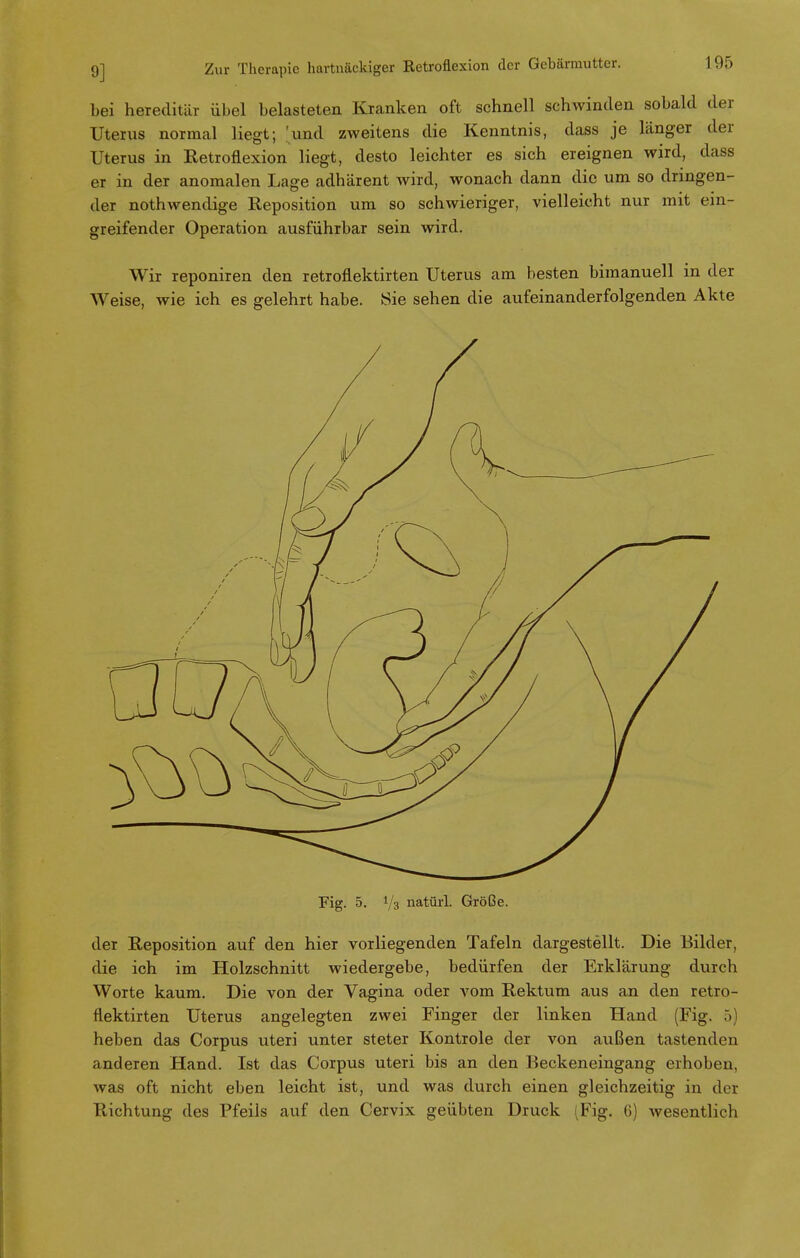 bei hereditär Übel belasteten Kranken oft schnell schwinden sobald der Uterus normal liegt; 'und zweitens die Kenntnis, dass je länger der Uterus in Retroflexion liegt, desto leichter es sich ereignen wird, dass er in der anomalen Lage adhärent wird, wonach dann die um so dringen- der nothwendige Reposition um so schwieriger, vielleicht nur mit ein- greifender Operation ausführbar sein wird. Wir reponiren den retroflektirten Uterus am besten bimanuell in der Weise, wie ich es gelehrt habe. Sie sehen die aufeinanderfolgenden Akte Fig. 5. Va natürl. Größe. der Reposition auf den hier vorliegenden Tafeln dargestellt. Die Bilder, die ich im Holzschnitt wiedergebe, bedürfen der Erklärung durch Worte kaum. Die von der Vagina oder vom Rektum aus an den retro- flektirten Uterus angelegten zwei Finger der linken Hand (Fig. 5) heben das Corpus uteri unter steter Kontrole der von außen tastenden anderen Hand. Ist das Corpus uteri bis an den Beckeneingang erhoben, was oft nicht eben leicht ist, und was durch einen gleichzeitig in der Richtung des Pfeils auf den Cervix geübten Druck (Fig. 6) wesentlich