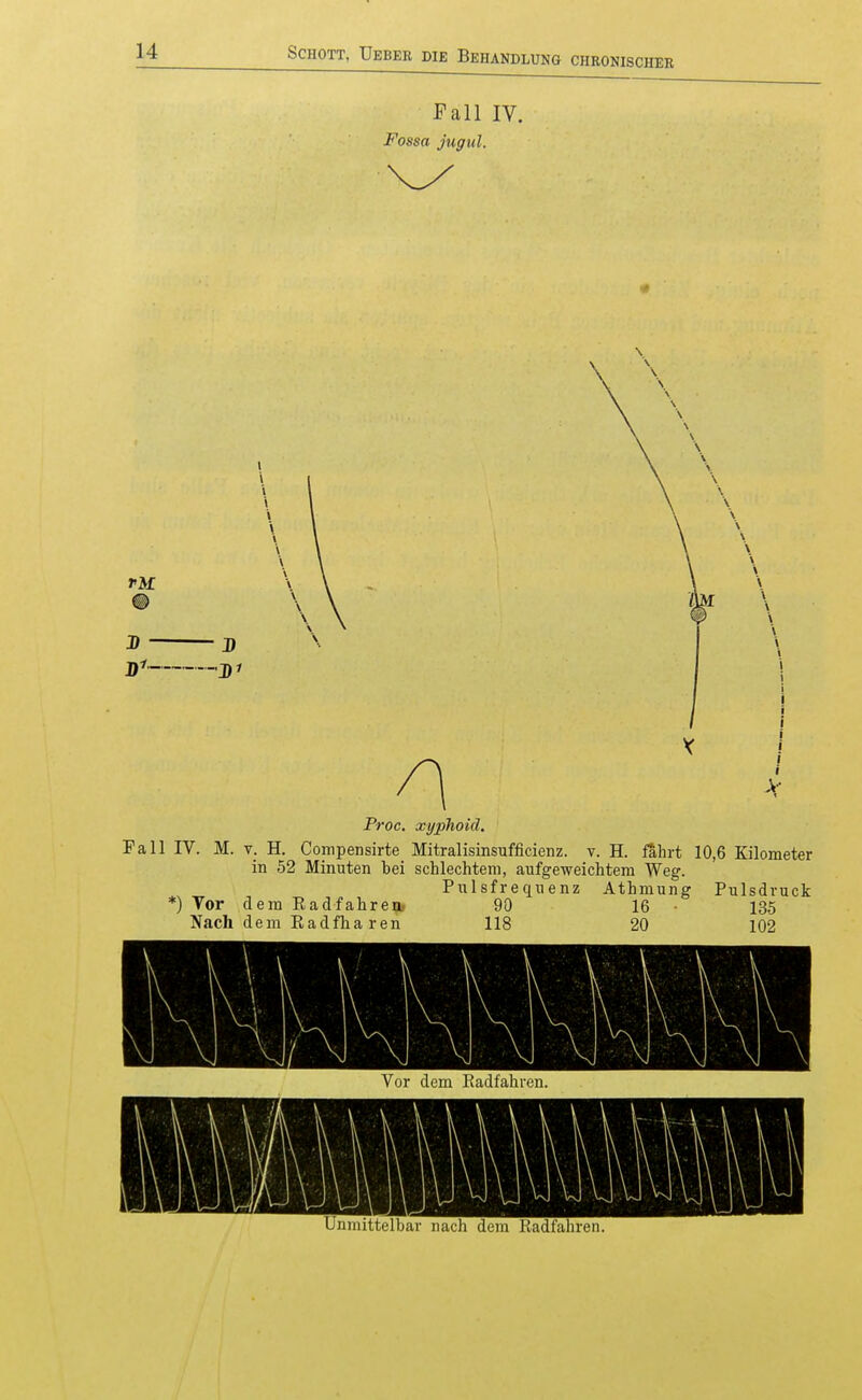 Fall IV. Fossa jugul. jfi jfi X Proc. xyphoid. Fall IV. M. V. H. Compensirte Mitralisinsufficienz. v. H. ß,hrt 10,6 Kilometer in 52 Minuten bei schlechtem, aufgeweichtem Weg. Pulsfrequenz Athmung Pulsdvuck *) Vor dem Eadfahren, 90 16 13.5 Nach dem Eadfha ren 118 20 102 Vor dem Radfahren.