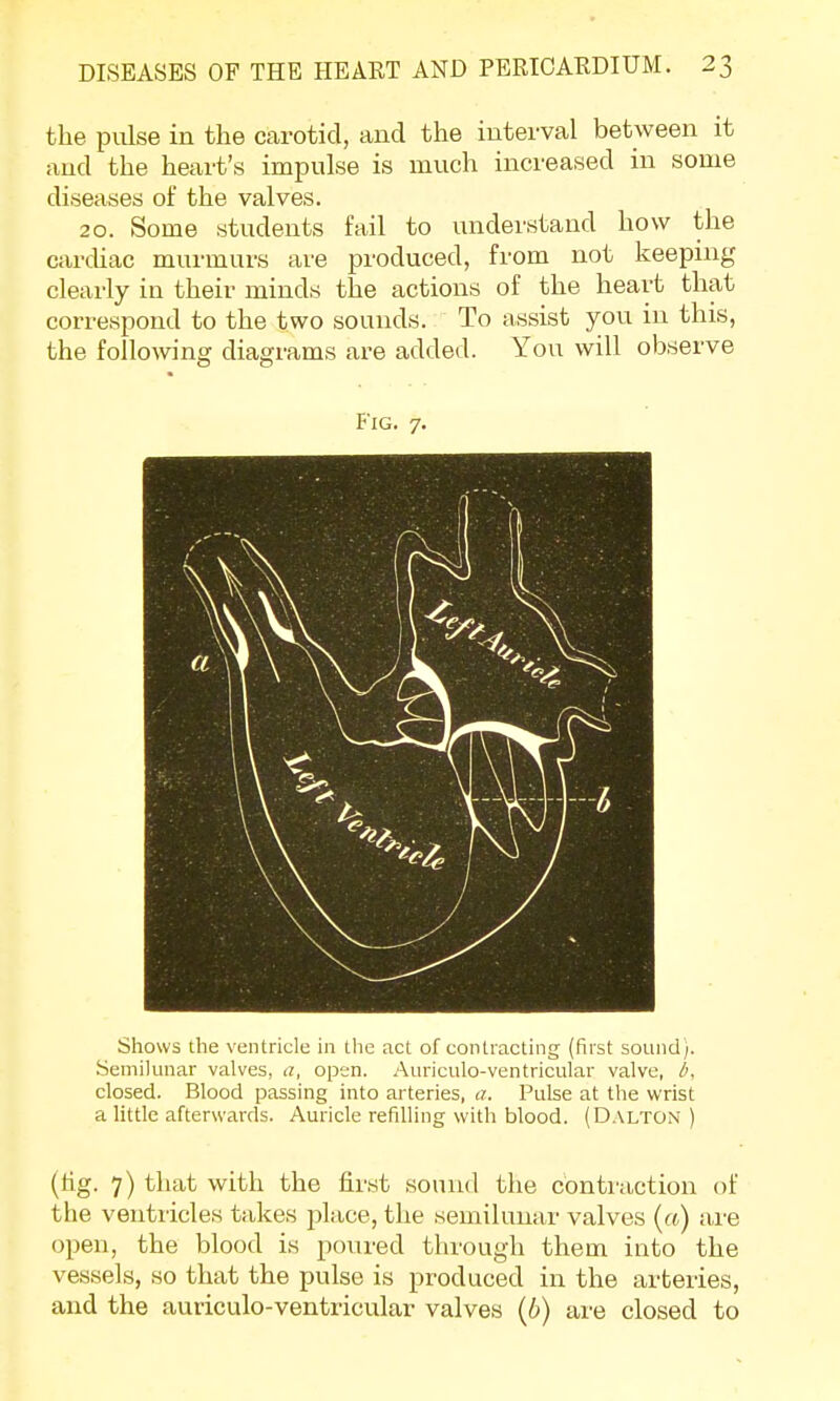 the pulse in the carotid, and the interval between it and the heart's impulse is much increased in some diseases of the valves. 20. Some students fail to understand how the cardiac murmurs are produced, from not keeping clearly in their minds the actions of the heart that correspond to the two sounds. To assist you in this, the following diagrams are added. You will observe Fig. 7. Shows the ventricle in the act of contracting (first sound). Semilunar valves, a, open. Auriculo-ventricular valve, b, closed. Blood passing into arteries, a. Pulse at the wrist a little afterwards. Auricle refilling with blood. (Dalton ) (tig. 7) that with the first sound the contraction of the ventricles takes place, the semilunar valves (a) are open, the blood is poured through them into the vessels, so that the pulse is produced in the arteries, and the auriculo-ventricular valves (b) are closed to