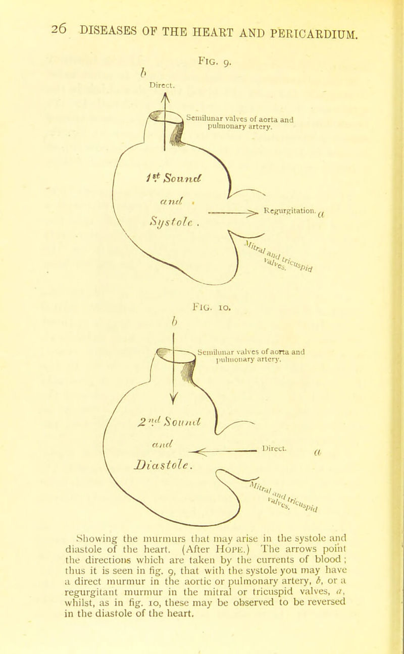 Fig. 9. 6 Dirccl. A Fig. 10. b Showing the murmurs that may arise in the systole and diastole of the heart. (After Home.) The arrows point the directions which are taken by the currents of blood ; thus it is seen in fig. 9, that with the systole you may have a direct murmur in the aortic or pulmonary artery, b, or a regurgitant murmur in the mitral or tricuspid valves, a, whilst, as in fig. 10, these may be observed to be reversed in the diastole of the heart.