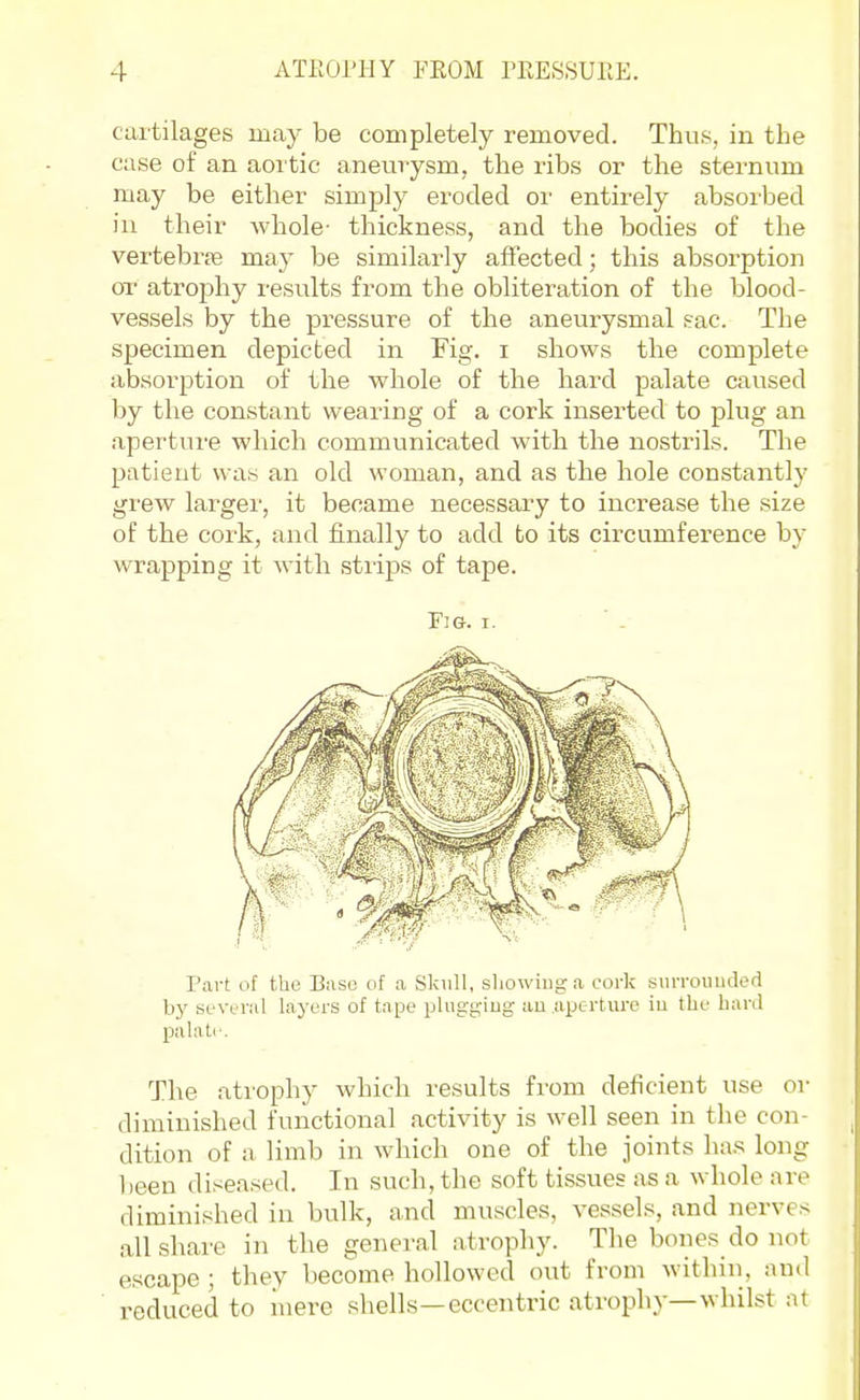 cartilages may be completely removed. Thus, in the case of an aortic aneurysm, the ribs or the sternum may be either simply eroded oi' entirely absorbed in their -whole- thickness, and the bodies of the vertebrfe may be similarly affected; this absorption OT atrophy results from the obliteration of the blood- vessels by the pressure of the aneurysmal sac. The specimen depicted in Fig. i shows the complete absoi'ption of the whole of the hard palate caused by the constant wearing of a cork inserted to plug an aperture which communicated with the nostrils. The patient was an old woman, and as the hole constantly grew larger, it became necessary to increase the size of the cork, and finally to add to its circumference by wrapping it with strips of tape. Fig. I. Part of the Baso of a Skull, sliowiuga cork siirroimded by si'Veral layers of tape pluggiug au aperture iu the bard palate. The atrophy which results from deficient use or diminished functional activity is well seen in the con- dition of a limb in which one of the joints has long l)een diseased. In such, the soft tissues as a whole are diminished in bulk, and muscles, vessels, and nerves all share in the general atrophy. The bones do not escape; they become hollowed out from within, and reduced to iuere shells—eccentric atrophy—whilst at