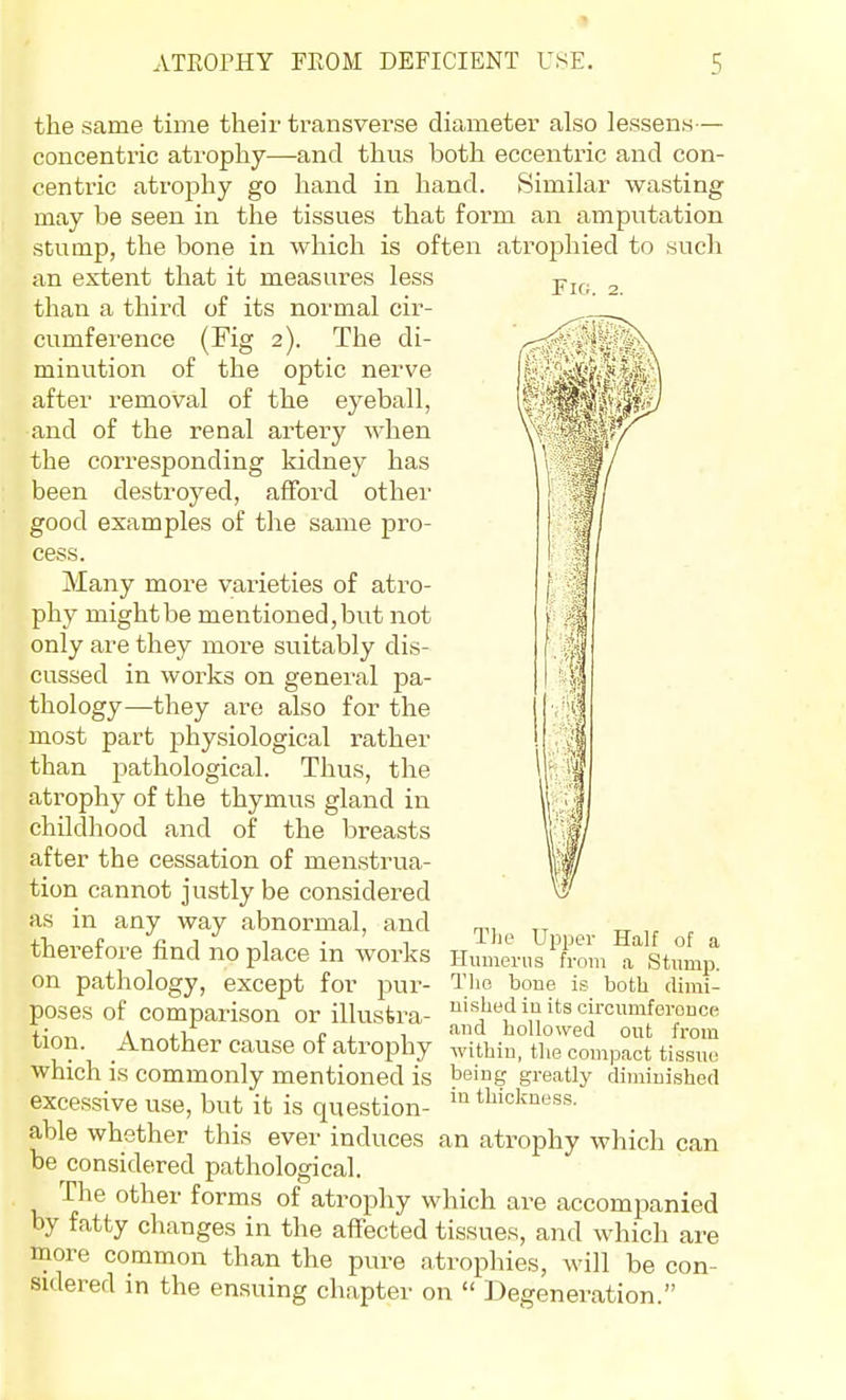 the same time their transverse diameter also lessens— concentric atrophy—-and thus both eccentric and con- centric atrophy go hand in hand. Similar wasting may be seen in the tissues that form an amputation stump, the bone in which is often atrophied to such an extent that it measures less -p^^. ^ than a third of its normal cir- cumference (Fig 2). The di- ll minution of the optic nerve after removal of the eyeball, and of the renal artery when the corresponding kidney has been destroyed, afford other good examples of the same pro- cess. Many more varieties of atro- phy might be mentioned, but not only are they more suitably dis- cussed in works on general pa- thology—they are also for the most part physiological rather than pathological. Thus, the atrophy of the thymvis gland in childhood and of the breasts after the cessation of menstrua- tion cannot justly be considered as in any way abnormal, and niv tt ^ +Vr...^r ^ 4i T ^ -1 Upper Half of a therefore find no place m works i-iumems from a Stump, on pathology, except for pur- 1'lie bone is both dimi- poses of comparison or illusfera- ii's|^«diuitscircumferonce +;^,, A j-iT c i_ 1 hollowed out from tion. Another cause of atrophy withiu, the compact tissue which is commonly mentioned is being greatly diminished excessive use, but it is question- able whether this ever induces an atrophy which can be considered pathological. The other forms of atrophy which are accompanied by fatty changes in the affected tissues, and which are more common than the pure atrophies, will be con- sidered in the ensuing chapter on  Degeneration.