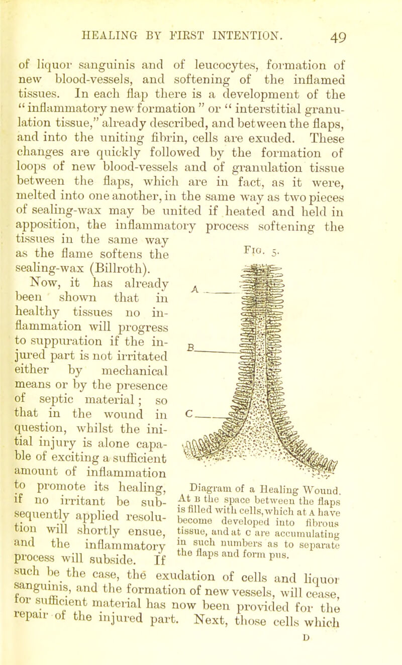 of liquol' sanguinis and of leucocytes, foi'mation of new blood-vessels, and softening of the inflamed tissues. In each flap there is a development of the  inflammatory new formation  or  interstitial granu- lation tissue, already described, and between the flaps, and into the uniting fibrin, cells are exuded. These changes are quickly followed by the formation of loops of new blood-vessels and of granulation tissue between the flajDS, which are in fact, as it were, melted into one another, in the same way as two pieces of sealing-wax may be united if heated and held in apposition, the inflammatory process softening the tissues in the same way as the flame softens the seaKng-wax (Billroth). Now, it has already been shown that in healthy tissues no in- flammation will 231'ogress to suppiu-ation if the in- jured part is not irritated either by mechanical means or by the presence of septic material; so that in the wound in question, whilst the ini- tial injury is alone capa- ble of exciting a sufficient amount of inflammation to promote its healing, if no irritant be sub- sequently applied resolu- tion will shortly ensue, and the inflammatory process will subside. If such be the case, the exudation of cells Diagram of a Healing Wound. At B the space between tlie flaps is filled with cells, which at A have become developed into fibrous tissue, and at c are accumulating m such numbers as to separate the flaps and form pus. . . ' - — and liquor sanguinis, and the formation of new vessels, will cmse tor sulicient mateiial has now been provided for the repair of the injured part. Next, those cells which D