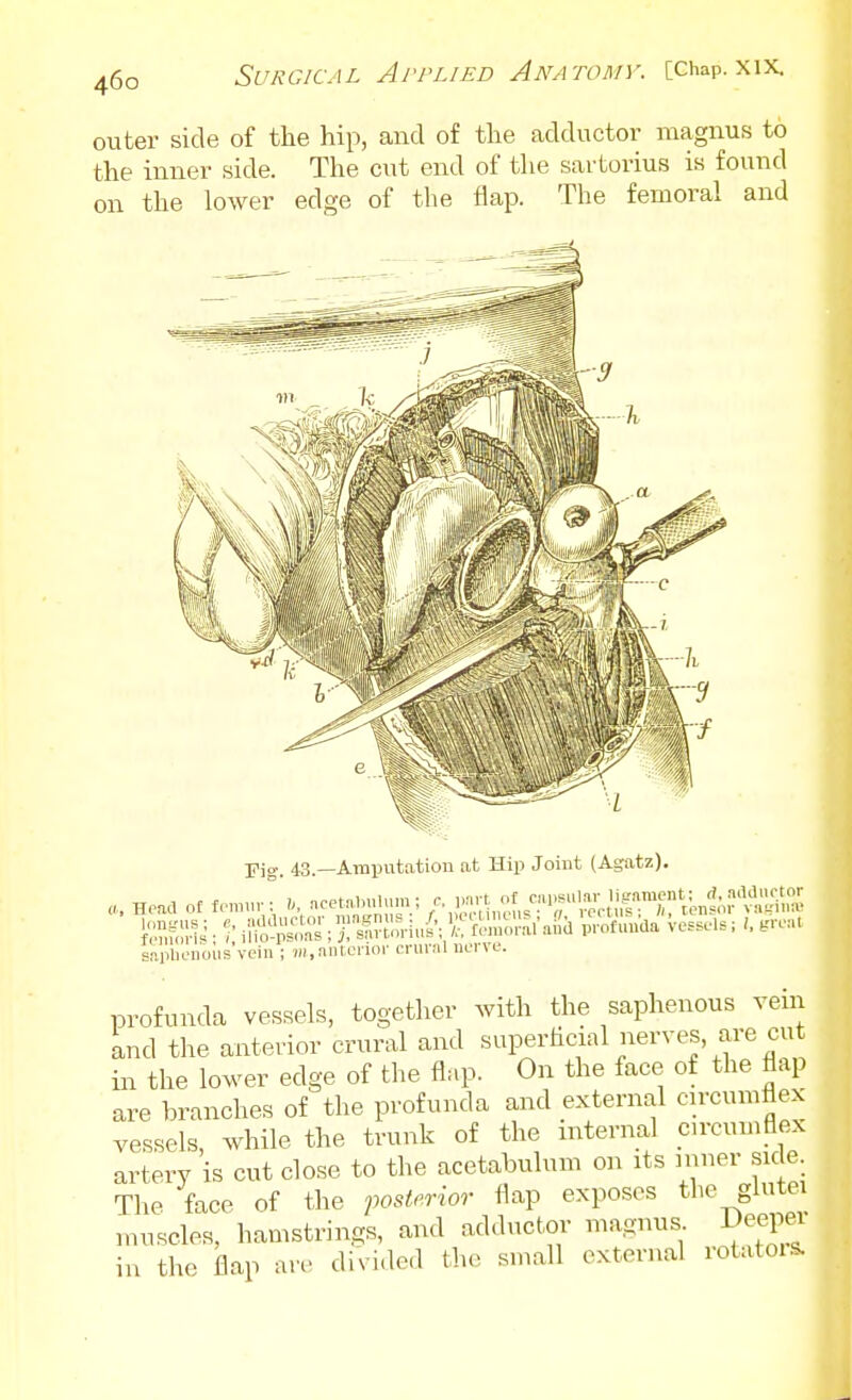 46c outer side of the hip, and of the adductor magnus to the inner side. The cut end of the sartorius is found on the lower edge of tlie flap. The femoral and Fig. 43.—Amijutatiou at Hip Joint (Agatz). Head o£ U-.J: ^ ncetalnUum ; V-^^.^^^^^^'^f'^^^^^^^ Vessels; .re,„ snpUeuous vein ; 7«, niiterior crural nerve. profunda vessels, together with the saphenous vein Lnd the anterior crural and superhcial ^^^rves, are cut in the lower edge of the flap. On the face of the flap are branches of the profunda and external cu-cuniflex vessels, while the trunk of the internal circumflex artery is cut clo.se to the acetabulum on its muer sic e The face of the foslerior flap exposes the glutei muscles, hamstrings, and adductor magnus Deeper in the flap are divided the small external lotatois.