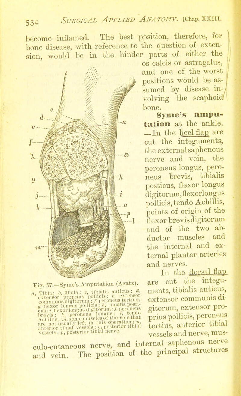 become inflamed. The best position, tlierefore, for bone disease, witli reference to the question of exten- sion, wotild be in the hinder parts of either the ' OS calcis or astragalus, and one of the worst positions would be as sumed by disease in volving the scaphoid', bone. Syme's ampu- tation at the ankle. —In the heel-flap are cut the integuments, the external saphenous nerve and vein, the peroneus longus, pero- neus brevis, tibialis posticus, flexor longus digitorum,flexorlongus pollicis,tendo Achillis, points of origin of the flexor brevis digitorvim and of the two ab- ductor muscles and the internal and ex- ternal plantar arteries and nerves. In the dO'-S'tl <^ap are cut the integu- ments, tibiahs anticus, extensor commimis di- gitorum, extensor pro- prius poUicis, peroneus tertiua, anterior tibial vessels and nerve, mus- culo-cutaneous nerve, mternal _ saphenous n^^^ and vein. The position of the principal stiuctuies rig. .57.—Syme's Amputation ^Aslltz). a Tiliia; 1, fllnila; c, tibialis anticus; d, extensor i.roprius imllicis; e, Cdiuniunis digltonun ; /, peroneus tei Us ■ ». nexor longus pollicis ; h, tibialis posti- cus ; /, ne-xor longus diguoruni -J, i;e'-™s brevis: /■•, peroneus longus; tinao Aclii lis; m, some muscles of tbo soletliat lire not usually Icit in tins operation anlerior tibial vessels ; o, posterior tibml vessels ; )), posterior tibial nerve.