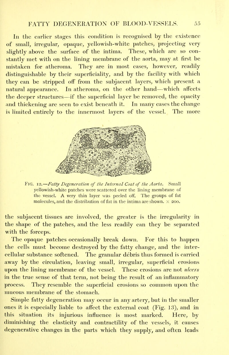 In the earlier stages this condition is recognised by the existence of small, irregular, opaque, yellowish-white patches, projecting very slightly above the surface of the intima. These, which are so con- stantly met with on the lining membrane of the aorta, may at first be mistaken for atheroma. They are in most cases, however, readily distinguishable by their superficiality, and by the facility with which they can be stripped off from the subjacent layers, which present a natural appearance. In atheroma, on the other hand—which affects the deeper structures—if the superficial layer be removed, the opacity and thickening are seen to exist beneath it. In many cases the change is limited entirely to the innermost layers of the vessel. The more Fig. 12.—Fatty Degeneration of the Internal Coat of the Aorta. Small yellowish-white patches were scattered over the lining membrane of the vessel. A very thin layer was peeled off. The groups of fat molecules, and the distribution of fat in the intima are shown, x 200. the subjacent tissues are involved, the greater is the irregularity in the shape of the patches, and the less readily can they be separated with the forceps. The opaque patches occasionally break down. For this to happen the cells must become destroyed by the fatty change, and the inter- cellular substance softened. The granular debris thus formed is carried away by the circulation, leaving small, irregular, superficial erosions upon the lining membrane of the vessel. These erosions are not ulcers in the true sense of that term, not being the result of an inflammatory process. They resemble the superficial erosions so common upon the mucous membrane of the stomach. Simple fatty degeneration may occur in any artery, but in the smaller ones it is especially liable to affect the external coat (Fig. 13), and in this situation its injurious influence is most marked. Here, by diminishing the elasticity and contractility of the vessels, it causes degenerative changes in the parts which they supply, and often leads