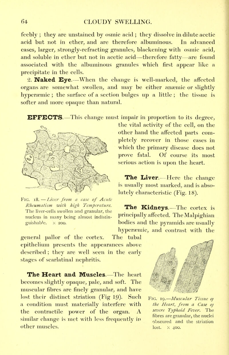 feebly ; they are unstained by osmic acid ; they dissolve in dilute acetic acid but not in ether, and are therefore albuminous. In advanced cases, larger, strongly-refracting granules, blackening with osmic acid, and soluble in ether but not in acetic acid—therefore fatty—are found associated with the albuminous granules which first appear like a precipitate in the cells. 2. Naked Eye.—When the change is well-marked, the affected organs are somewhat swollen, and may be either ana?mic or slightly hypersemic ; the surface of a section bulges up a little ; the tissue is softer and more opaque than natural. EFFECTS.—This change must impair in proportion to its degree, ^ the vital activity of the cell, on the other hand the affected parts com- pletely recover in those cases in which the primary disease does not prove fatal. Of course its most serious action is upon the heart. The Liver.—Here the change is usually most marked, and is abso- lutely characteristic (Fig. 18). Fig. i8.—Liver from a case of Acute Rheumatism with high Temperature. The liver-cells swollen and granular, the nucleus in many being almost indistin- guishable. X 200. general pallor of the cortex epithelium presents the appearances above described ; they are well seen in the early stages of scarlatinal nephritis. The Heart and Muscles.—The heart becomes slightly opaque, pale, and soft. The muscular fibres are finely granular, and have lost their distinct striation (Fig 19). Such a condition must materially interfere with the contractile power of the organ. A similar change is met with less frequently in (.)ther muscles. The Kidneys.—The cortex is })rincipally affected. The Malpighian bodies and the pyramids are usually hyperaemic, and contrast with the The tubal Fig. 19.—Muscular Tissue oj the Heart, from a Case oj severe Typhoid Fever. The fibres are granular, the nuclei obscured and the striation lost. X 400.