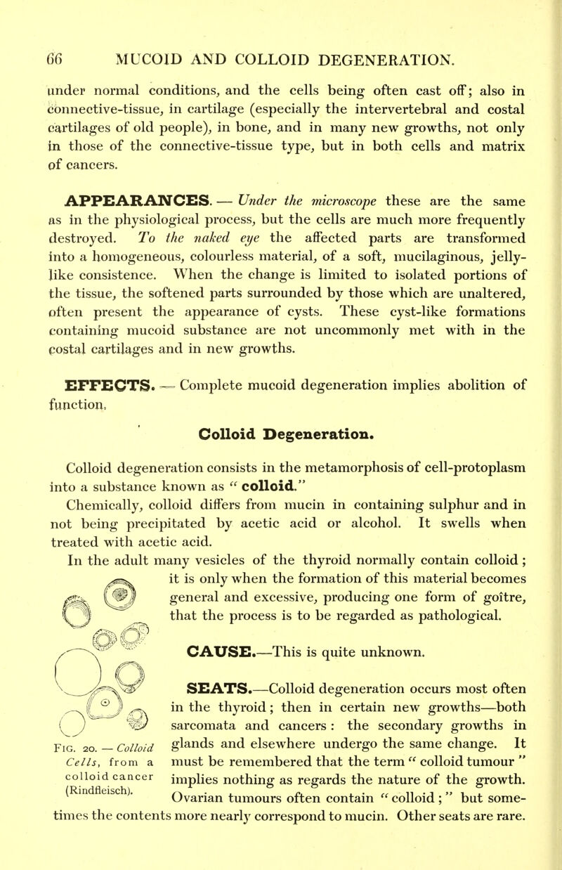 under normal conditions, and the cells being often cast off; also in connective-tissue, in cartilage (especially the intervertebral and costal cartilages of old people), in bone, and in many new growths, not only in those of the connective-tissue type, but in both cells and matrix of cancers. APPEARANCES. — Under the microscope these are the same as in the physiological process, but the cells are much more frequently destroyed. To the jiaked eye the affected parts are transformed into a homogeneous, colourless material, of a soft, mucilaginous, jelly- like consistence. When the change is limited to isolated portions of the tissue, the softened parts surrounded by those which are unaltered, often present the appearance of cysts. These cyst-like formations containing mucoid substance are not uncommonly met with in the postal cartilages and in new gx'owths. EFFECTS* — Complete mucoid degeneration implies abolition of function. Colloid Degeneration. Colloid degeneration consists in the metamorphosis of cell-protoplasm into a substance known as  colloid. Chemically, colloid differs from mucin in containing sulphur and in not being precipitated by acetic acid or alcohol. It swells when treated with acetic acid. In the adult many vesicles of the thyroid normally contain colloid; it is only when the formation of this material becomes general and excessive, producing one form of goitre, that the process is to be regarded as pathological. CAUSE.—-This is quite unknown. SEATS.—Colloid degeneration occurs most often in the thyroid; then in certain new growths—both sarcomata and cancers : the secondary growths in Fig. 20. — Colloid glands and elsewhere undergo the same change. It Cells, from a must be remembered that the term  colloid tumour  colloid cancer implies nothing as regards the nature of the growth, in eisc . Ovarian tumours often contain colloid ;  but some- times the contents more nearly correspond to mucin. Other seats are rare.