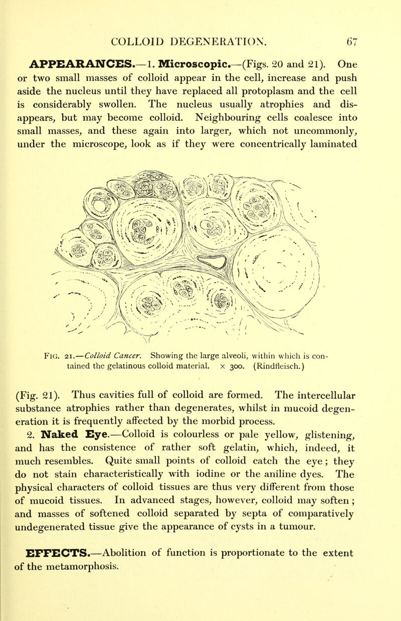 APPEARANCES.—1. Microscopic—(Figs. 20 and 21). One or two small masses of colloid appear in the cell, increase and push aside the nucleus until they have replaced all protoplasm and the cell is considerably swollen. The nucleus usually atrophies and dis- appears, but may become colloid. Neighbouring cells coalesce into small masses, and these again into larger, which not uncommonly, under the microscope, look as if they were concentrically laminated Fig. 21.—Colloid Cancer. Showing the large alveoli, within which is con- tained the gelatinous colloid material. X 300. (Rindfieisch.) (Fig. 21). Thus cavities full of colloid are formed. The intercellular substance atrophies rather than degenerates, whilst in mucoid degen- eration it is frequently affected by the morbid process. 2. Naked Eye.—Colloid is colourless or pale yellow, glistening, and has the consistence of rather soft gelatin, which, indeed, it much resembles. Quite small points of colloid catch the eye; they do not stain characteristically with iodine or the aniline dyes. The physical characters of colloid tissues are thus very different from those of mucoid tissues. In advanced stages, however, colloid may soften; and masses of softened colloid separated by septa of comparatively undegenerated tissue give the appearance of cysts in a tumour. EFFECTS.—Abolition of function is proportionate to the extent of the metamorphosis.