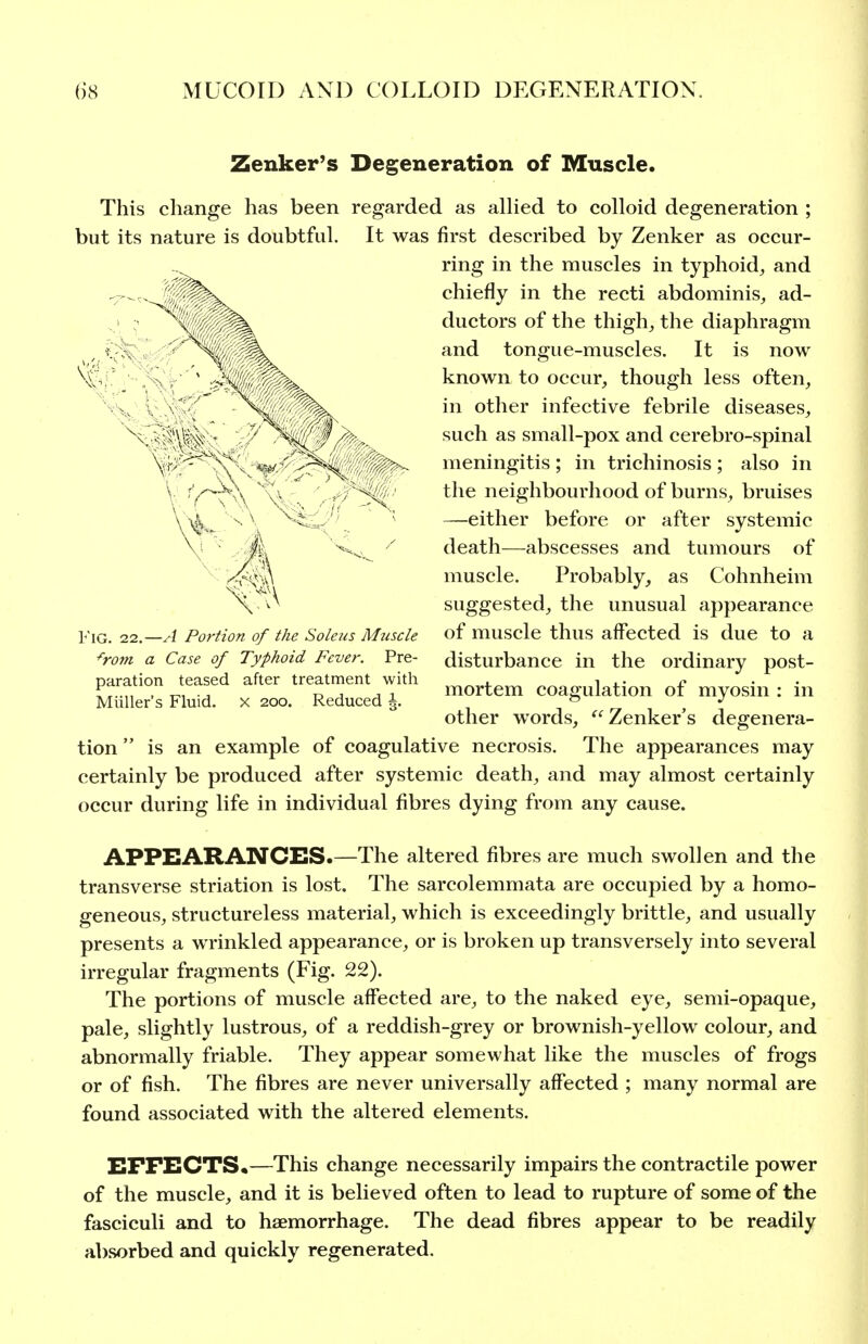 Zenker's Degeneration of Muscle. This change has been regarded as allied to colloid degeneration ; but its nature is doubtful. It was first described by Zenker as occur- ring in the muscles in typhoid, and chiefly in the recti abdominis, ad- ductors of the thigh, the diaphragm and tongue-muscles. It is now . ' Mlk^^^ known to occur, though less often, in other infective febrile diseases, such as small-pox and cerebro-spinal meningitis ; in trichinosis ; also in the neighbourhood of burns, bruises —either before or after systemic death—abscesses and tumours of muscle. Probably, as Cohnheim suggested, the unusual appearance of muscle thus affected is due to a disturbance in the ordinary post- mortem coagulation of myosin : in other w^ords, Zenker's degenera- tion  is an example of coagulative necrosis. The appearances may certainly be produced after systemic death, and may almost certainly occur during life in individual fibres dying from any cause. APPEARANCES.—The altered fibres are much swollen and the transverse striation is lost. The sarcolemmata are occupied by a homo- geneous, structureless material, which is exceedingly brittle, and usually presents a wrinkled appearance, or is broken up transversely into several irregular fragments (Fig. 22). The portions of muscle affected are, to the naked eye, semi-opaque, pale, slightly lustrous, of a reddish-grey or brownish-yellow colour, and abnormally friable. They appear somewhat like the muscles of frogs or of fish. The fibres are never universally affected ; many normal are found associated with the altered elements. Fig. 22.—A Portion of the Soleus Mtiscle ^rom a Case of Typhoid Fever. paration teased after treatment Miiller's Fluid, x 200. Pre- with Reduced i. EFFECTS.—This change necessarily impairs the contractile power of the muscle, and it is believed often to lead to rupture of some of the fasciculi and to haemorrhage. The dead fibres appear to be readily a])sorbed and quickly regenerated.