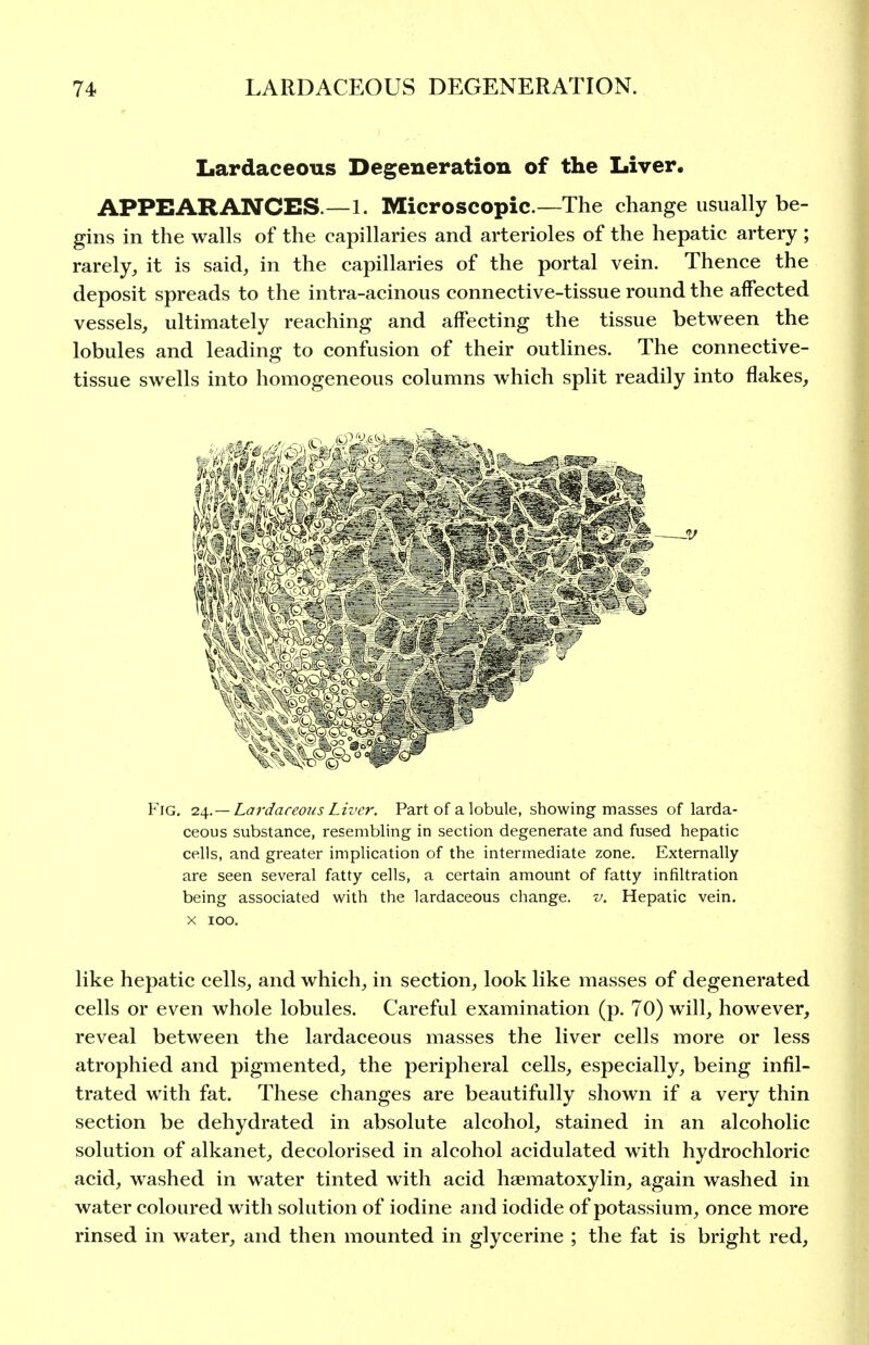 Lardaceous Degeneration of the Liver. APPEARANCES.—1. Microscopic.—The change usually be- gins in the walls of the capillaries and arterioles of the hepatic artery ; rarely, it is said, in the capillaries of the portal vein. Thence the deposit spreads to the intra-acinous connective-tissue round the affected vessels, ultimately reaching and affecting the tissue between the lobules and leading to confusion of their outlines. The connective- tissue swells into homogeneous columns which split readily into flakes, Fig. lif. —Lardaceous Liver. Part of a lobule, showing masses of larda- ceous substance, resembling in section degenerate and fused hepatic cells, and greater implication of the intermediate zone. Externally are seen several fatty cells, a certain amount of fatty infiltration being associated with the lardaceous change, v. Hepatic vein. X ICO, like hepatic cells, and which, in section, look like masses of degenerated cells or even whole lobules. Careful examination (p. 70) will, however, reveal between the lardaceous masses the liver cells more or less atrophied and pigmented, the peripheral cells, especially, being infil- trated with fat. These changes are beautifully shown if a very thin section be dehydrated in absolute alcohol, stained in an alcoholic solution of alkanet, decolorised in alcohol acidulated with hydrochloric acid, washed in water tinted with acid haematoxylin, again washed in water coloured with solution of iodine and iodide of potassium, once more rinsed in water, and then mounted in glycerine ; the fat is bright red.