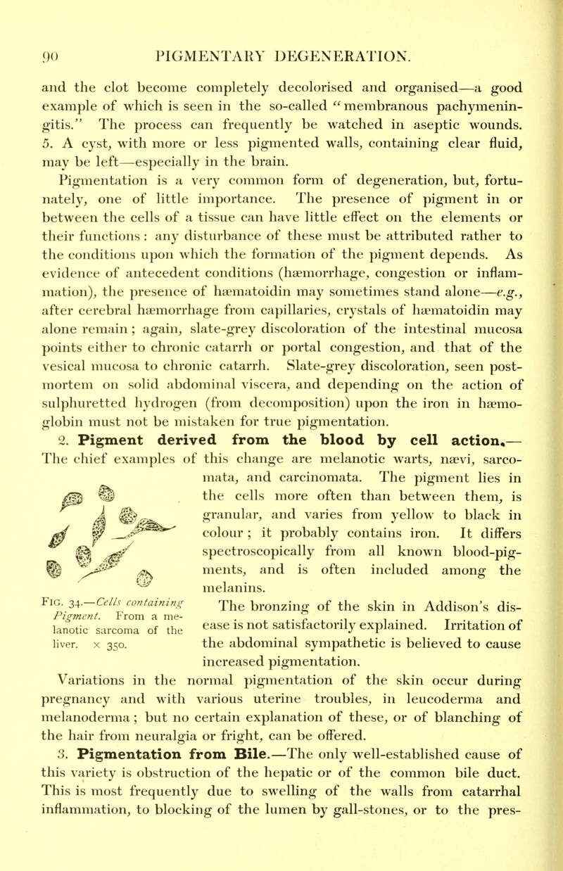and the clot become completely decolorised and organised—a good example of which is seen in the so-called  membranous pachymenin- gitis. The process can frequently be watched in aseptic wounds. 5. A cyst, with more or less pigmented walls, containing clear fluid, may be left—especially in the brain. Pigmentation is a very common form of degeneration, but, fortu- nately, one of little importance. The presence of pigment in or between the cells of a tissue can have little effect on the elements or their functions : any disturbance of these must be attributed rather to the conditions upon which the formation of the pigment depends. As evidence of antecedent conditions (haemorrhage, congestion or inflam- mation), the presence of haematoidin may sometimes stand alone—e.g., after cerebral haemorrhage from capillaries, crystals of haematoidin may alone remain; again, slate-grey discoloration of the intestinal mucosa points either to chronic catarrh or portal congestion, and that of the vesical mucosa to chronic catarrh. Slate-grey discoloration, seen post- mortem on solid abdominal viscera, and depending on the action of sulphuretted hydrogen (from decomposition) upon the iron in haemo- globin must not be mistaken for true pigmentation. 2. Pigment derived from the blood by cell action*— The chief examples of this change are melanotic warts, naevi, sarco- mata, and carcinomata. The pigment lies in the cells more often than between them, is granular, and varies from yellow to black in colour ; it probably contains iron. It differs spectroscopically from all known blood-pig- ments, and is often included among the ^ melanins. Fig. 34.-a//.r cor?tainir^g The bronzing of the skin in Addison's dis- Pigment. From a me- , . ^ ., i • i t lanotic sarcoma of the ^^^^ satistactorily explamed. Irritation or liver. X 350. the abdominal sympathetic is believed to cause increased pigmentation. Variations in the normal pigmentation of the skin occur during pregnancy and with various uterine troubles, in leucoderma and melanoderma; but no certain explanation of these, or of blanching of the hair from neuralgia or fright, can be offered. 3. Pigmentation from Bile.—The only well-established cause of this variety is obstruction of the hepatic or of the common bile duct. This is most frequently due to swelling of the walls from catarrhal inflammation, to blocking of the lumen by gall-stones, or to the pres-