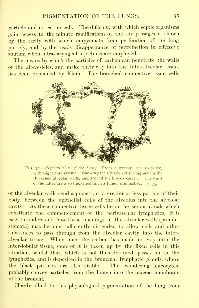 particle and its carrier cell. The difficulty with which septic organisms gain access to the minute ramifications of the air passages is shown by the rarity with which empyemata from perforation of the lung putrefy, and by the ready disappearance of putrefaction in offensive sputum when intra-laryngeal injections are employed. The means by which the particles of carbon can penetrate the walls of tlie air-vesicles, and make their way into the inter-alveolar tissue, has been explained by Klein. The branched connective-tissue cells Fig. 35.—Pif^tncntatioii of (he Lufti^. From a woman, xi. sixty-iive, with slight emphysema. Showing the situation of the pigment in the thickened alveolar walls, and around the blood-vessel v. The walls of the latter are also thickened and its lumen diminished, x 75. of the alveolar walls send a process, or a greater or less portion of their body, between the e})itlielial cells of the alveolus into the alveolar cavity. As these coimective-tissue cells lie in the serous canals which constitute the commencement of the })erivascular lymphatics, it is easy to understand how these openings in the alveolar walls (pseudo- stomata) may become sufficiently distended to allow cells and other substances to pass through from the alveolar cavity into the inter- alveolar tissue. Wlien once the carbon has made its way into the inter-lobular tissue, some of it is taken up by the fixed cells in this situation, w^hilst that, which is not thus detained, passes on to the lymphatics, and is deposited in the bronchial lymphatic glands, where the black particles are also visible. The wandering leucocytes, probably convey particles from the lumen into the mucous membrane of the bronchi. Closely allied to this physiological })igmentation of the lung from
