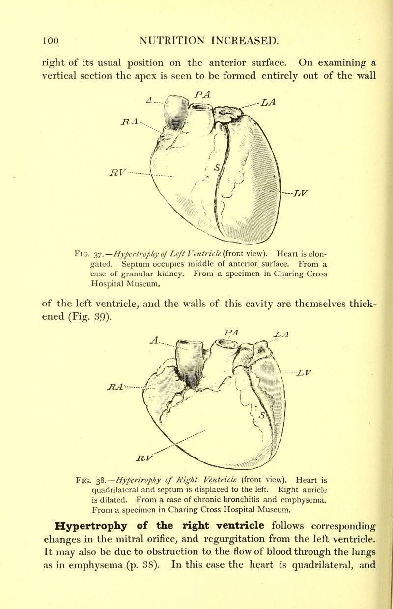 right of its usual position on the anterior surface. On examining a vertical section the apex is seen to be formed entirely out of the wall Fig. -^j.—Hypertrophy of Left Ventricle [ixovA view). Heart is elon- gated. Septum occupies middle of anterior surface. From a case of granular kidney. From a specimen in Charing Cross Hospital Museum. of the left ventricle, and the walls of this cavity are themselves thick- ened (Fig. 39). ItA- Fig. 38.—Hypertrophy of Right Ventricle (front view). Heart is quadrilateral and septum is displaced to the left. Right auricle is dilated. From a case of chronic bronchitis and emphysema. From a specimen in Charing Cross Hospital Museum. Hypertrophy of the right ventricle follows corresponding changes in the mitral orifice, and regurgitation from the left ventricle. It may also be due to obstruction to the flow of blood through the lungs as in emphysema (p. 38). In this case the heart is quadrilateral, and