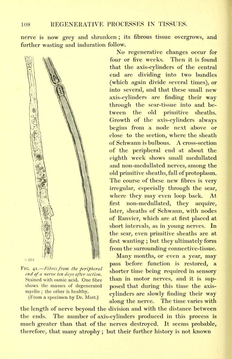 nerve is now grey and shrunken ; its fibrous tissue overgrows,, and further wasting and induration follow. No regenerative changes occur for four or five weeks. Then it is found that the axis-cylinders of the central end are dividing into two bundles (which again divide several times), or into several, and that these small new axis-cylinders are finding their way through the scar-tissue into and be- tween the old primitive sheaths. Growth of the axis-cylinders always begins from a node next above or close to the section, where the sheath of Schwann is bulbous. A cross-section of the peripheral end at about the eighth week shows small meduUated and non-medullated nerves, among the old primitive sheaths, full of protoplasm. The course of these new fibres is very irregular, especially through the scar, where they may even loop back. At first non-medullated, they acquire, later, sheaths of Schwann, with nodes of Ranvier, which are at first placed at short intervals, as in young nerves. In the scar, even primitive sheaths are at first wanting ; but they ultimately form from the surrounding connective-tissue. Many months, or even a year, may pass before function is restored, a shorter time being required in sensory than in motor nerves, and it is sup- posed that during this time the axis- cylinders are slowly finding their way along the nerve. The time varies with the length of nerve beyond the division and with the distance between the ends. The number of axis-cylinders produced in this process is much greater than that of the nerves destroyed. It seems probable, tlierefore, that many atrophy; but their further history is not known Fig. 41.—Fibresfi'om the peripheral end of a nerve ten days after section. Stained with osmic acid. One fibre shows the masses of degenerated myehn ; the other is heahhy. (From a specimen by Dr. Mott.) (