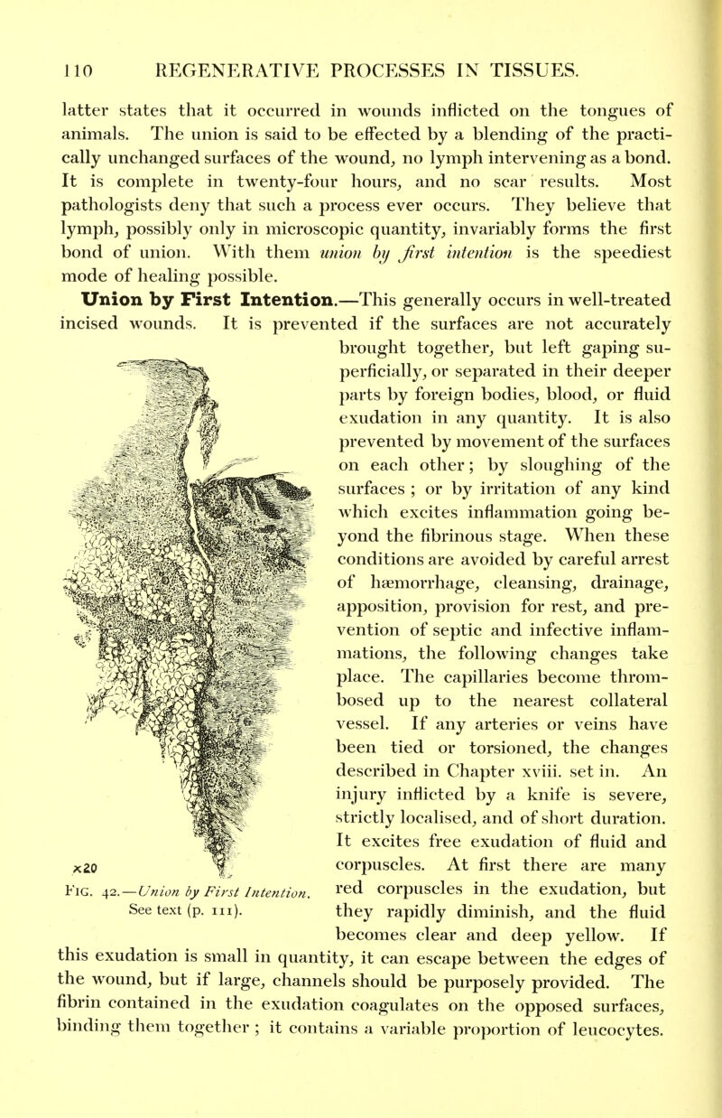 latter states that it occurred in wounds inflicted on the tongues of animals. The union is said to be effected by a blending of the practi- cally unchanged surfaces of the wound^ no lymph intervening as a bond. It is complete in twenty-four hours^ and no scar results. Most pathologists deny that such a process ever occurs. They believe that lymph^ possibly only in microscopic quantity, invariably forms the first bond of union. With them union hi) first intention is the speediest mode of healing jjossible. Union by First Intention.—This generally occurs in well-treated incised wounds. It is prevented if the surfaces are not accurately brought together, but left gaping su- perficially, or separated in their deeper parts by foreign bodies, blood, or fluid exudation in any quantity. It is also prevented by movement of the surfaces on each other; by sloughing of the surfaces ; or by irritation of any kind which excites inflammation going be- yond the fibrinous stage. When these conditions are avoided by careful arrest of haemorrhage, cleansing, drainage, apposition, provision for rest, and pre- vention of septic and infective inflam- mations, the following changes take place. The capillaries become throm- bosed up to the nearest collateral vessel. If any arteries or veins have been tied or torsioned, the changes described in Chapter xviii. set in. An injury inflicted by a knife is severe, strictly localised, and of short duration. It excites free exudation of fluid and corpuscles. At first there are many Fig. ■^2.—Union by Firsi Intention. 1'^^ corpuscles in the exudation, but See text (p. iii). they rapidly diminish, and the fluid becomes clear and deep yellow. If this exudation is small in quantity, it can escape between the edges of the wound, but if large, channels should be purposely provided. The fibrin contained in the exudation coagulates on the opposed surfaces, binding them together ; it contains a variable proportion of leucocytes.