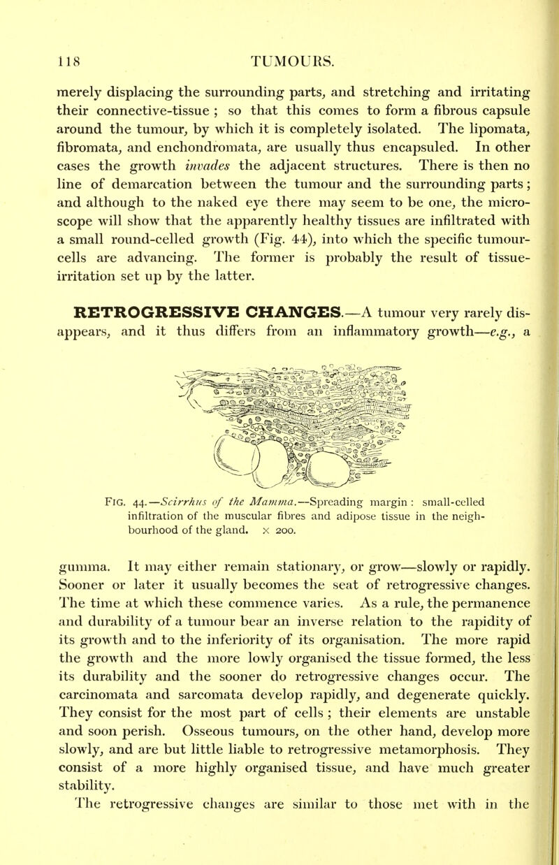 merely displacing the surrounding parts^ and stretching and irritating their connective-tissue ; so that this comes to form a fibrous capsule around the tumour, by which it is completely isolated. The lipomata, fibromata, and enchondromata, are usually thus encapsuled. In other cases the growth invades the adjacent structures. There is then no line of demarcation between the tumour and the surrounding parts; and although to the naked eye there may seem to be one, the micro- scope will show that the apparently healthy tissues are infiltrated with a small round-celled growth (Fig. 44), into which the specific tumour- cells are advancing. The former is probably the result of tissue- irritation set up by the latter. RETROGRESSIVE CHANGES.—A tumour very rarely dis- appears, and it thus differs from an inflammatory growth—e,g., a Fig. 44.—Scirrhus of the Mavima.—Spreading margin : small-celled infiltration of the muscular fibres and adipose tissue in the neigh- bourhood of the gland, x 200. gumma. It may either remain stationary, or grow—slowly or rapidly. Sooner or later it usually becomes the seat of retrogressive changes. The time at which these commence varies. As a rule, the permanence and durability of a tumour bear an inverse relation to the rapidity of its growth and to the inferiority of its organisation. The more rapid the growth and the more lowly organised the tissue formed, the less its durability and the sooner do retrogressive changes occur. The carcinomata and sarcomata develop rapidly, and degenerate quickly. They consist for the most part of cells ; their elements are unstable and soon perish. Osseous tumours, on the other hand, develop more slowly, and are but little liable to retrogressive metamorphosis. They consist of a more highly organised tissue, and have much greater stability. The retrogressive changes are similar to those met with in the