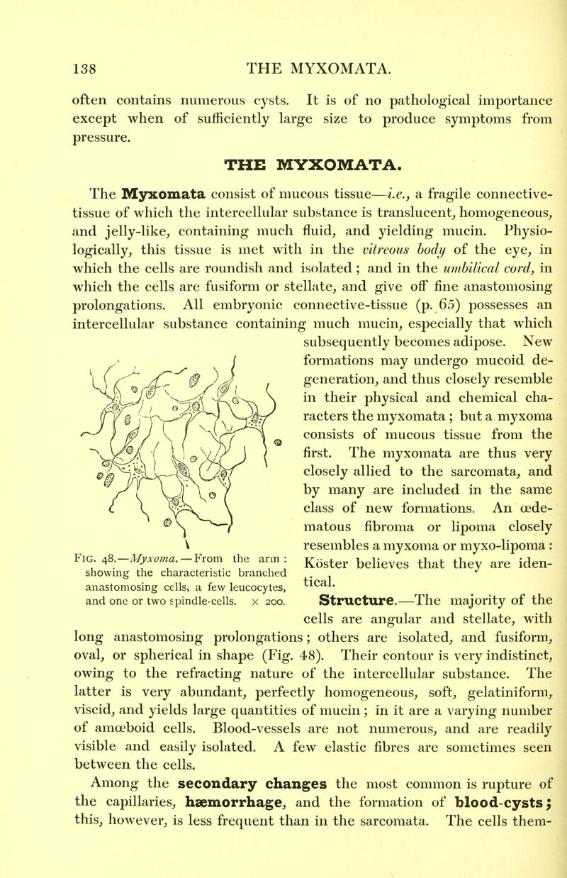 often contains numerous cysts. It is of no pathological importance except when of sufficiently large size to produce symptoms from pressure. THE MYXOMATA. The Myxomata consist of mucous tissue—i.e., a fragile connective- tissue of which the intercellular substance is translucent^ homogeneous, and jelly-like, containing much fluid, and yielding mucin. Physio- logically, this tissue is met with in the vitreous body of the eye, in which the cells are roundish and isolated; and in the imihilical cord, in which the cells are fusiform or stellate, and give off fine anastomosing prolongations. All embryonic connective-tissue (p. 65) possesses an intercellular substance containing much mucin, especially that which subsequently becomes adipose. New formations may undergo mucoid de- generation, and thus closely resemble in their physical and chemical cha- racters the myxomata ; but a myxoma consists of mucous tissue from the first. The myxomata are thus very closely allied to the sarcomata, and by many are included in the same class of new formations. An oede- matous fibroma or lipoma closely V resembles a myxoma or myxo-lipoma : Fig ^^.-Myxoma.-Yvom the arm: j^^^^^^, beheves that they are iden- showing the characteristic branched , *^ anastomosing cells, a few leucocytes, ticai. and one or two spindle-cells, x 200. Structure.—The majority of the cells are angular and stellate, with long anastomosing prolongations; others are isolated, and fusiform, oval, or spherical in shape (Fig. 48). Their contour is very indistinct, owing to the refracting nature of the intercellular substance. The latter is very abtmdant, perfectly homogeneous, soft, gelatiniform, viscid, and yields large quantities of mucin ; in it are a varying number of amoeboid cells. Blood-vessels are not numerous, and are readily visible and easily isolated. A few elastic fibres are sometimes seen between the cells. Among the secondary changes the most common is rupture of the capillaries, haemorrhage, and the formation of blood-cysts 5 this, however, is less frequent than in the sarcomata. The cells them-
