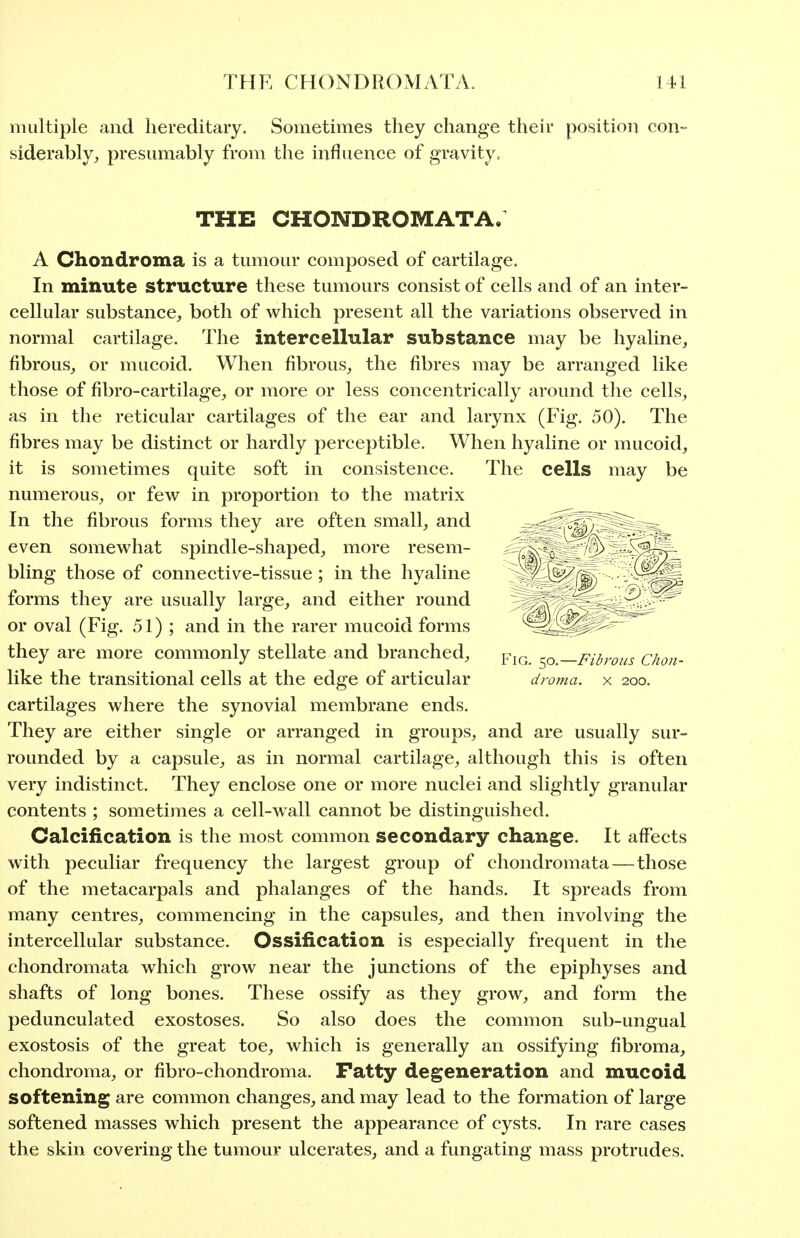 multiple and hereditary. Sometimes they change their position con- siderably^ presumably from the influence of gravity. A Chondroma is a tumour composed of cartilage. In minute structure these tumours consist of cells and of an inter- cellular substance, both of which present all the variations observed in normal cartilage. The intercellular substance may be hyaline, fibrous, or mucoid. When fibrous, the fibres may be arranged like those of fibro-cartilage, or more or less concentrically ai'ound the cells, as in the reticular cartilages of the ear and larynx (Fig. 50). The fibres may be distinct or hardly perceptible. When hyaline or mucoid, it is sometimes quite soft in consistence. The cells may be numerous, or few in proportion to the matrix rounded by a capsule, as in normal cartilage, although this is often very indistinct. They enclose one or more nuclei and slightly granular contents ; sometimes a cell-wall cannot be distinguished. Calcification is the most common secondary change. It affects with peculiar frequency the largest group of chondromata—those of the metacarpals and phalanges of the hands. It spreads from many centres, commencing in the capsules, and then involving the intercellular substance. Ossification is especially frequent in the chondromata which grow near the junctions of the epiphyses and shafts of long bones. These ossify as they grow, and form the pedunculated exostoses. So also does the common sub-ungual exostosis of the great toe, which is generally an ossifying fibroma, chondroma, or fibro-chondroma. Fatty degeneration and mucoid softening are common changes, and may lead to the formation of large softened masses which present the appearance of cysts. In rare cases the skin covering the tumour ulcerates, and a fungating mass protrudes. THE CHONDROMATA.