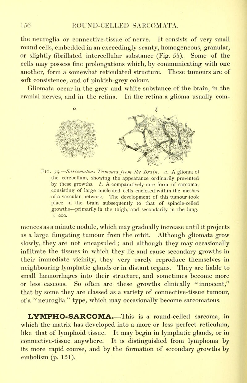 the neuroglia or connective-tissue of nerve. It consists of very small round cells, embedded in an exceedingly scanty, homogeneous, granular, or slightly fibrillated intercellular substance (Fig. 55). Some of the cells may possess fine prolongations which, by communicating with one another, form a somewhat reticulated structure. These tumours are of soft consistence, and of pinkish-grey colour. Gliomata occur in the grey and white substance of the brain, in the cranial nerves, and in the retina. In the retina a glioma usually com- FiG. 55.—Sa?roi?iafo//s Tumours from the Braiu. a. A glioma of the cerebellum, showing the appearance ordinarily presented by these growths, b. A comparatively rare form of sarcoma, consisting of large nucleated cells enclosed within the meshes of a vascular network. The development of this tumour took place in the brain subsequently to that of spindle-celled growths—primarily in the thigh, and secondarily in the lung. X 200. mences as a minute nodule, which may gradually increase until it projects as a large fungating tumour from the orbit. Although gliomata grow slowly, they are not encapsuled ; and although they may occasionally infiltrate the tissues in which they lie and cause secondary growths in their immediate vicinity, they very rarely reproduce themselves in neighbouring lymphatic glands or in distant organs. They are liable to small haemorrhages into their structure, and sometimes become more or less caseous. So often are these growths clinically innocent, that by some they are classed as a variety of connective-tissue tumour, of a neuroglia type, which may occasionally become sarcomatous. IiYMPHO-SARCOMA.—This is a round-celled sarcoma, in which the matrix has developed into a more or less perfect reticulum, like that of lymphoid tissue. It may begin in lymphatic glands, or in connective-tissue anywhere. It is distinguished from lymphoma by its more rapid course, and by the formation of secondary growths by embolism (p. 151),