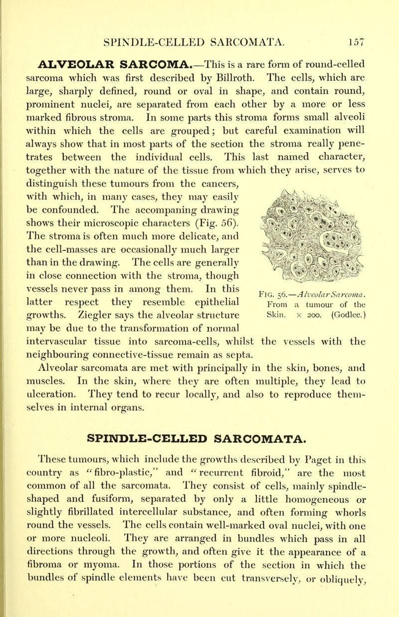 ALVEOLAR SARCOMA.—This is a rare form of round-celled sarcoma which was first described by Billroth. The cells^ which are large, sharply defined, round or oval in shape, and contain round, prominent nuclei, are separated from each other by a more or less marked fibrous stroma. In some parts this stroma forms small alveoli within which the cells are grouped; but careful examination will always show that in most parts of the section the stroma really pene- trates between the individual cells. This last named character, together with the nature of the tissue from which they arise, serves to distinguish these tumours from the cancers, with which, in many cases, they may easily be confounded. The accompaning drawing shows their microscopic characters (Fig. 56). The stroma is often much more delicate, and the cell-masses are occasionally much larger than in the drawing. The cells are generally in close connection with the stroma, though vessels never pass in among them. In this latter respect they resemble epithelial growths. Ziegler says the alveolar structure may be due to the transformation of normal intervascular tissue into sarcoma-cells, whilst the vessels with the neighbouring connective-tissue remain as septa. Alveolar sarcomata are met with principally in the skin, bones, and muscles. In the skin, where they are often multiple, they lead to ulceration. They tend to recur locally, and also to reproduce them- selves in internal organs. SPINDLE-CELLED SARCOMATA. These tumours, which include the growths described by Paget in this country as fibro-plastic, and recurrent fibroid, are the most common of all the sarcomata. They consist of cells, mainly spindle- shaped and fusiform, separated by only a little homogeneous or slightly fibrillated intercellular substance, and often forming whorls round the vessels. The cells contain well-marked oval nuclei, with one or more nucleoli. They are arranged in bundles which pass in all directions through the growth, and often give it the appearance of a fibroma or myoma. In those portions of the section in which the bundles of spindle elements have been cut transversely, or obliquely. Fig. 56.—Alveolar Sarcoma. From a tumour of the Skin. X 200. (Godlee.)