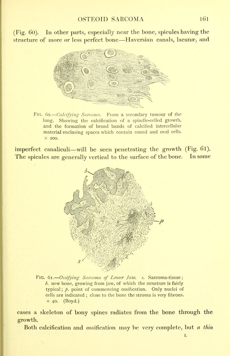 (Fig. 60). In other parts^ especially near the bone, spicules having the structure of more or less perfect bone—Haversian canals, lacunae, and Fig. 60.—Calcifying Sarcoma. From a secondary tumour of the lung. Showing the calcification of a spindle-celled growth, and the formation of broad bands of calcified intercellular material enclosing spaces which contain round and oval cells. X 200. imperfect canaliculi—will be seen penetrating the growth (Fig. 6I). The spicules are generally vertical to the surface of the bone. In some Fig. 61.—Ossifying Sarcoma of Lower Jaw. s. Sarcoma-tissue ; d. new bone, growing from jaw, of which the structure is fairly typical; /. point of commencing ossification. Only nuclei of cells are indicated ; close to the bone the stroma is very fibrous. X 40. (Boyd.) cases a skeleton of bony spines radiates from the bone through the growth. Both calcification and ossification may be very complete, but a thin L