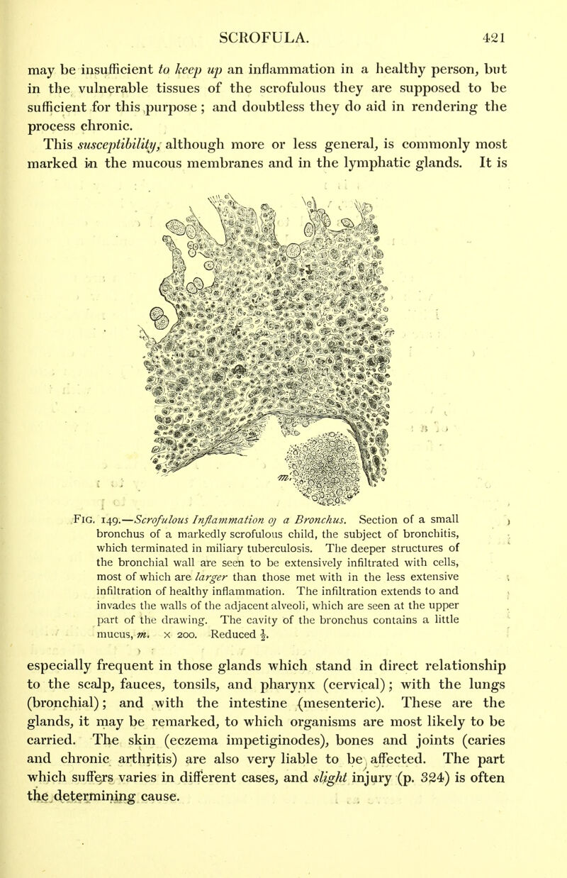 may be insufficient to keep up an inflammation in a healthy person, but in the vulnerable tissues of the scrofulous they are supposed to be sufficient for this purpose ; and doubtless they do aid in rendering the process chronic. This susceptibilitT/, although more or less general, is commonly most marked i-n the mucous membranes and in the lymphatic glands. It is Fig, 149,—Scrofulous Inflammation oj a Bronchus. Section of a small bronchus of a markedly scrofulous child, the subject of bronchitis, , ; which terminated in miliary tuberculosis. The deeper structures of the bronchial wall are seen to be extensively infiltrated with cells, most of which are larger than those met with in the less extensive 1 infiltration of healthy inflammation. The infiltration extends to and invades the walls of the adjacent alveoli, which are seen at the upper part of the drawing. The cavity of the bronchus contains a little mucus, m> x 200. Reduced \. especially frequent in those glands which stand in direct relationship to the scalp, fauces, tonsils, and pharynx (cervical); with the lungs (bronchial); and with the intestine (mesenteric). These are the glands, it may be remarked, to which organisms are most likely to be carried. The skin (eczema impetiginodes), bones and joints (caries and chronic arthritis) are also very liable to be affected. The part which suffers varies in different cases, and slight injury (p. 324) is often the determining cause. i . , ,
