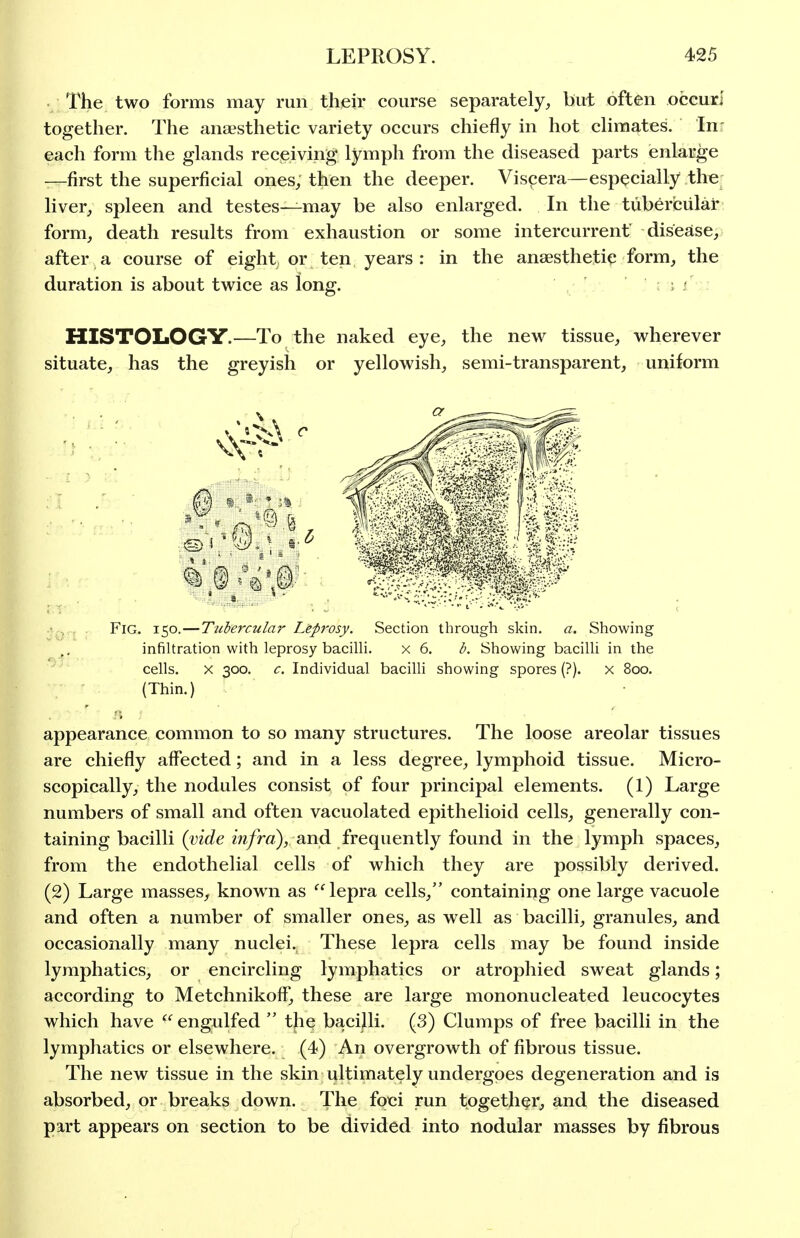 The two forms may run their course separately, but often occur! together. The anaesthetic variety occurs chiefly in hot cHmates. In- each form the glands receiving lymph from the diseased parts enlarge —first the superficial ones, then the deeper. Viscera—especially the: liver, spleen and testes—may be also enlarged. In the tubercular form, death results from exhaustion or some intercurrent' disease, after a course of eight or ten years: in the anaesthetic form, the duration is about twice as long. ; : HISTOLOGY.—To the naked eye, the new tissue, wherever situate, has the greyish or yellowish, semi-transparent, uniform ■l^r, ■ Fig. 150.—Tubercular Leprosy. Section through skin. a. Showing infiltration with leprosy baciUi. x 6. b. Showing bacilli in the cells. X 300. c. Individual bacilli showing spores (?). x 800. (Thin.) appearance common to so many structures. The loose areolar tissues are chiefly affected; and in a less degree, lymphoid tissue. Micro- scopically, the nodules consist of four principal elements. (1) Large numbers of small and often vacuolated epithelioid cells, generally con- taining bacilli {vide m/ra), and frequently found in the lymph spaces, from the endothelial cells of which they are possibly derived. (2) Large masses, known as lepra cells, containing one large vacuole and often a number of smaller ones, as well as bacilli, granules, and occasionally many nuclei. These lepra cells may be found inside lymphatics, or encircling lymphatics or atrophied sweat glands; according to Metchnikofl, these are large mononucleated leucocytes which have  engulfed  the bacilli. (3) Clumps of free bacilli in the lymphatics or elsewhere. (4) An overgrowth of fibrous tissue. The new tissue in the skin ultimately undergoes degeneration and is absorbed, or breaks down. The foci run together, and the diseased part appears on section to be divided into nodular masses by fibrous