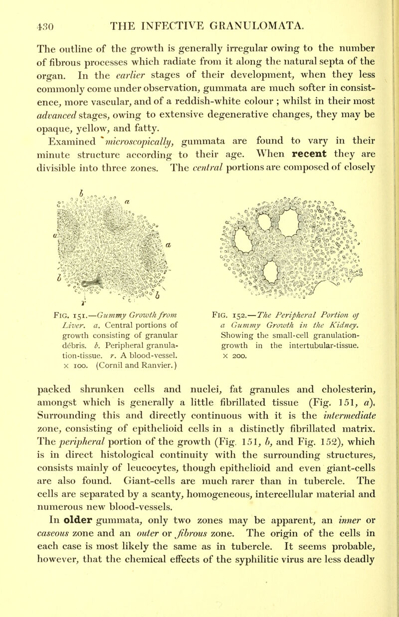 The outline of the growth is generally irregular owing to the number of fibrous processes which radiate from it along the natural septa of the organ. In the earlier stages of their development^ when they less commonly come under observation, gummata are much softer in consist- ence, more vascular, and of a reddish-white colour ; whilst in their most advanced stages, owing to extensive degenerative changes, they may be opaque, yellow, and fatty. Examined ^microscopically, gummata are found to vary in their minute structure according to their age. When recent they are divisible into three zones. The central portions are composed of closely Fig. 151.—Gummy Growth from Liver, a. Central portions of growth consisting of granular d(^bris. b. Peripheral granula- tion-tissue, r. A blood-vessel. X 100. (Cornil and Ranvier.) Fig. 152.—The Peripheral Portion oj a Gumjny Growth in the Kidney. Showing the small-cell granulation- growth in the intertubular-tissue. X 200. packed shrunken cells and nuclei, fat granules and cholesterin, amongst which is generally a little fibrillated tissue (Fig. 151, «), Surrounding this and directly continuous with it is the intermediate zone, consisting of epithelioid cells in a distinctly fibrillated matrix. The peripheral portion of the growth (Fig. 151, h, and Fig. 152), which is in direct histological continuity with the surrounding structures, consists mainly of leucocytes, though epithelioid and even giant-cells are also found. Giant-cells are much rarer than in tubercle. The cells are separated by a scanty, homogeneous, intercellular material and numerous new blood-vessels. In older gummata, only two zones may be apparent, an inner or caseous zone and an outer or fibrous zone. The origin of the cells in each case is most likely the same as in tubercle. It seems probable, however, that the chemical effects of the syphilitic virus are less deadly