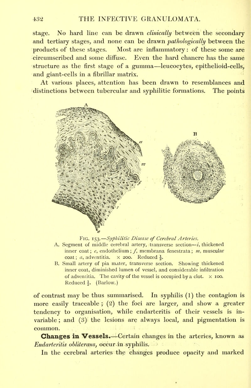 stage. No hard line can be drawn clinically between the secondary and tertiary stages^ and none can be drawn j)athologically between the products of these stages. Most are inflammatory: of these some are circumscribed and some diffuse. Even the hard chancre has the same structure as the first stage of a gumma—leucocytes,, epithelioid-cells, and giant-cells in a fibrillar matrix. At various places, attention has been drawn to resemblances and distinctions between tubercular and syphilitic formations. The points A Fig. 153.—Syphilitic Disease of Cerebral Arteries. A. Segment of middle cerebral artery, tiansverse section—/, thickened inner coat; e, endothelium ; f, membrana feneslrata ; m, muscular coat; ^z, adventitia. x 200. Reduced \. B, Small artery of pia mater, transverse section. Showing thickened inner coat, diminished lumen of vessel, and considerable infiltration of adventitia. The cavity of the vessel is occupied by a clot, x 100. Reduced |. (Barlow.) of contrast may be thus summarised. In syphilis (1) the contagion is more easily traceable ; (2) the foci are larger, and show a greater tendency to organisation, while endarteritis of their vessels is in- variable ; and (3) the lesions are always local, and pigmentation is common. Changes in Vessels,—Certain changes in the arteries, known as Endarteritis obliterans, occur in syphilis. In the cerebral arteries the changes produce opacity and marked
