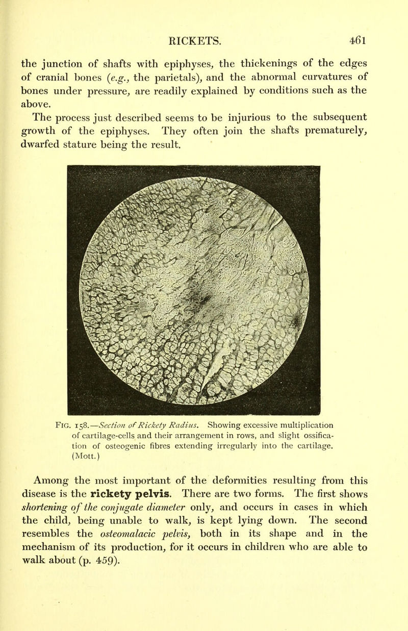the junction of shafts with epiphyses, the thickenings of the edges of cranial bones {e.g., the parietals), and the abnormal curvatures of bones under pressure, are readily explained by conditions such as the above. The process just described seems to be injurious to the subsequent growth of the epiphyses. They often join the shafts prematurely, dwarfed stature being the result. Fig. 158,—Section of Rickety Radius. Showing excessive multiplication of cartilage-cells and their arrangement in rows, and slight ossifica- tion of osteogenic fibres extending irregularly into the cartilage. (Mott.) Among the most important of the deformities resulting from this disease is the rickety pelvis. There are two forms. The first shows shortening of the conjugate diatneter only, and occurs in cases in which the child, being unable to walk, is kept lying down. The second resembles the osteomalacic pelvis, both in its shape and in the mechanism of its production, for it occurs in children who are able to walk about (p. 459).