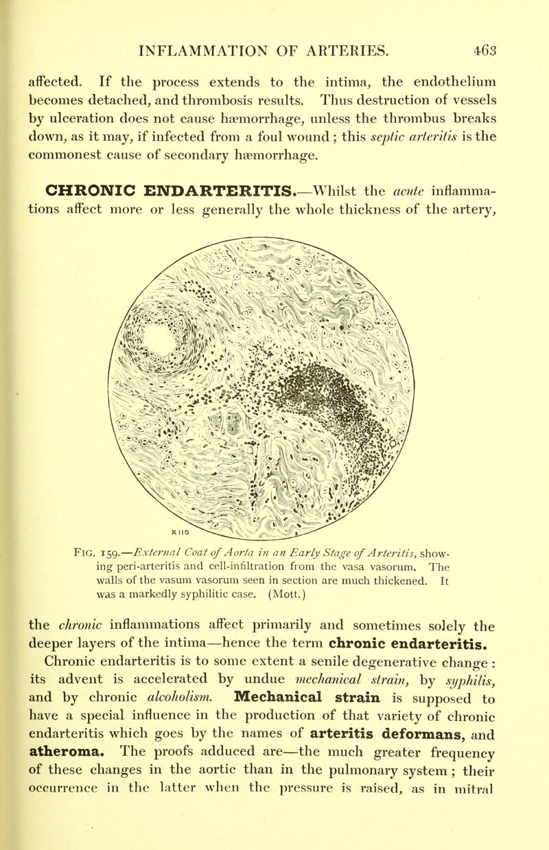 affected. If the process extends to the intima, the endothelium becomes detached, and thrombosis results. Thus destruction of vessels by ulceration does not cause haemorrhage, unless the thrombus breaks down, as it may, if infected from a foul wound ; this septic arteritis is the commonest cause of secondary haemorrhage. CHRONIC ENDARTERITIS Whilst the acute inflamma- tions affect more or less generally the whole thickness of the artery. Fig, 159.—External Coat of Aorta in an Early Stage of Arteritis, show- ing peri-arteritis and cell-infiltration from the vasa vasorum. The walls of the vasum vasorum seen in section are much thickened. It was a markedly syphilitic case. (Mott.) the chronic inflammations affect primarily and sometimes solely the deeper layers of the intima—hence the term chronic endarteritis. Chronic endarteritis is to some extent a senile degenerative change : its advent is accelerated by undue mechanical strain, by syphilis, and by chronic alcoholism. Mechanical strain is supposed to have a special influence in the production of that variety of chronic endarteritis which goes by the names of arteritis deformans, and atheroma. The proofs adduced are—the much greater frequency of these changes in the aortic than in the pulmonary system ; their occurrence in the latter when the jiressure is raised, as in mitral