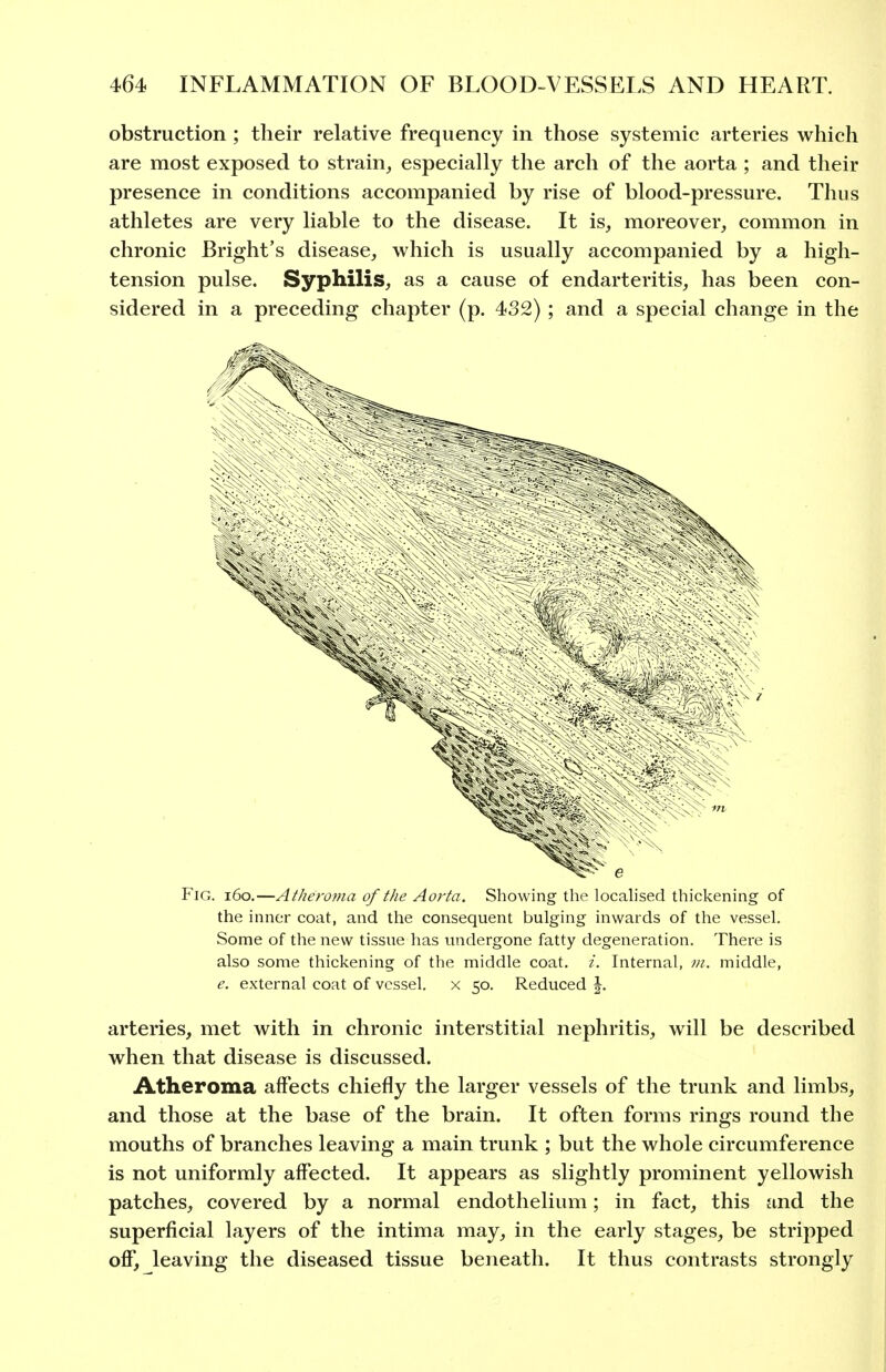obstruction ; their relative frequency in those systemic arteries which are most exposed to strain^ especially the arch of the aorta ; and their presence in conditions accompanied by rise of blood-pressure. Thus athletes are very liable to the disease. It is, moreover, common in chronic Bright's disease, which is usually accompanied by a high- tension pulse. Syphilis, as a cause of endarteritis, has been con- sidered in a preceding chapter (p. 432) ; and a special change in the Fig. i6o.—Atheroma of the Aorta. Showing the locab'sed thickening of the inner coat, and the consequent bulging inwards of the vessel. Some of the new tissue has undergone fatty degeneration. There is also some thickening of the middle coat. i. Internal, m. middle, e. external coat of vessel, x 50. Reduced |. arteries, met with in chronic interstitial nephritis, will be described when that disease is discussed. Atheroma affects chiefly the larger vessels of the trunk and limbs, and those at the base of the brain. It often forms rings round the mouths of branches leaving a main trunk ; but the whole circumference is not uniformly affected. It appears as slightly prominent yellowish patches, covered by a normal endothelium; in fact, this and the superficial layers of the intima may, in the early stages, be stripped off, leaving the diseased tissue beneath. It thus contrasts strongly