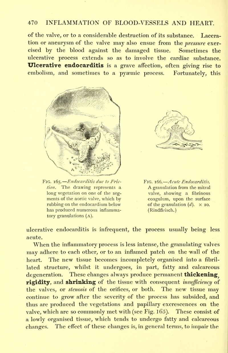 of the valve, or to a considerable destruction of its substance. Lacera- tion or aneurysm of the valve may also ensue from the pressure exer- cised by the blood against the damaged tissue. Sometimes the ulcerative process extends so as to involve the cardiac substance. Ulcerative endocarditis is a grave affection, often giving rise to embolism, and sometimes to a pyaemic process. Fortunately, this Fig. 165.—Endocarditis due to Fric- tion. The drawing represents a long vegetation on one of the seg- ments of the aortic valve, which by- rubbing on the endocardium below has produced numerous inflamma- tory granulations (a). Fig. 166.—Ac7ite Endocarditis. A granulation from the mitral valve, showing a fibrinous coagulum, upon the surface of the granulation {d). x 10. (Rindfleisch.) ulcerative endocarditis is infrequent, the process usually being less acute. When the inflammatory process is less intense, the granulating valves may adhere to each other, or to an inflamed patch on the wall of the heart. The new tissue becomes incompletely organised into a fibril- lated structure, whilst it undergoes, in part, fatty and calcareous degeneration. These changes always produce permanent thickening^ rigidity, and shrinking of the tissue with consequent insiifficienci/ of the valves, or stenosis of the orifices, or both. The new tissue may continue to grow after the severity of the process has subsided, and thus are produced the vegetations and papillary excrescences on the valve, which are so commonly met with (see Fig. 165). These consist of a lowly organised tissue, which tends to undergo fatty and calcareous changes. The effect of these changes is, in general terms, to impair the