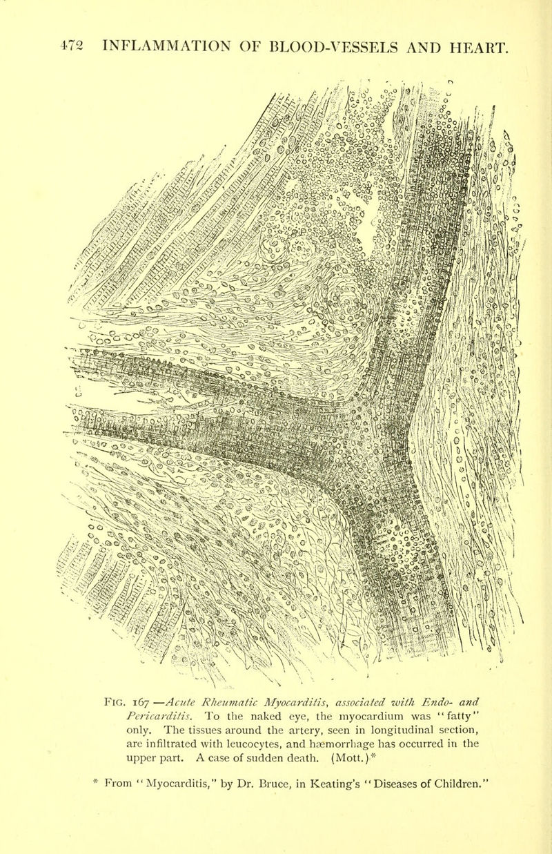 Fig. 167 —Acute Rheumatic Myocarditis, associated with Endo- and Pericarditis. To the naked eye, the myocardium was fatty only. The tissues around the artery, seen in longitudinal section, are infiltrated with leucocytes, and haemorrhage has occurred in the upper part. A case of sudden death. (Mott.) * * From Myocarditis, by Dr. Bruce, in Keating's  Diseases of Children.