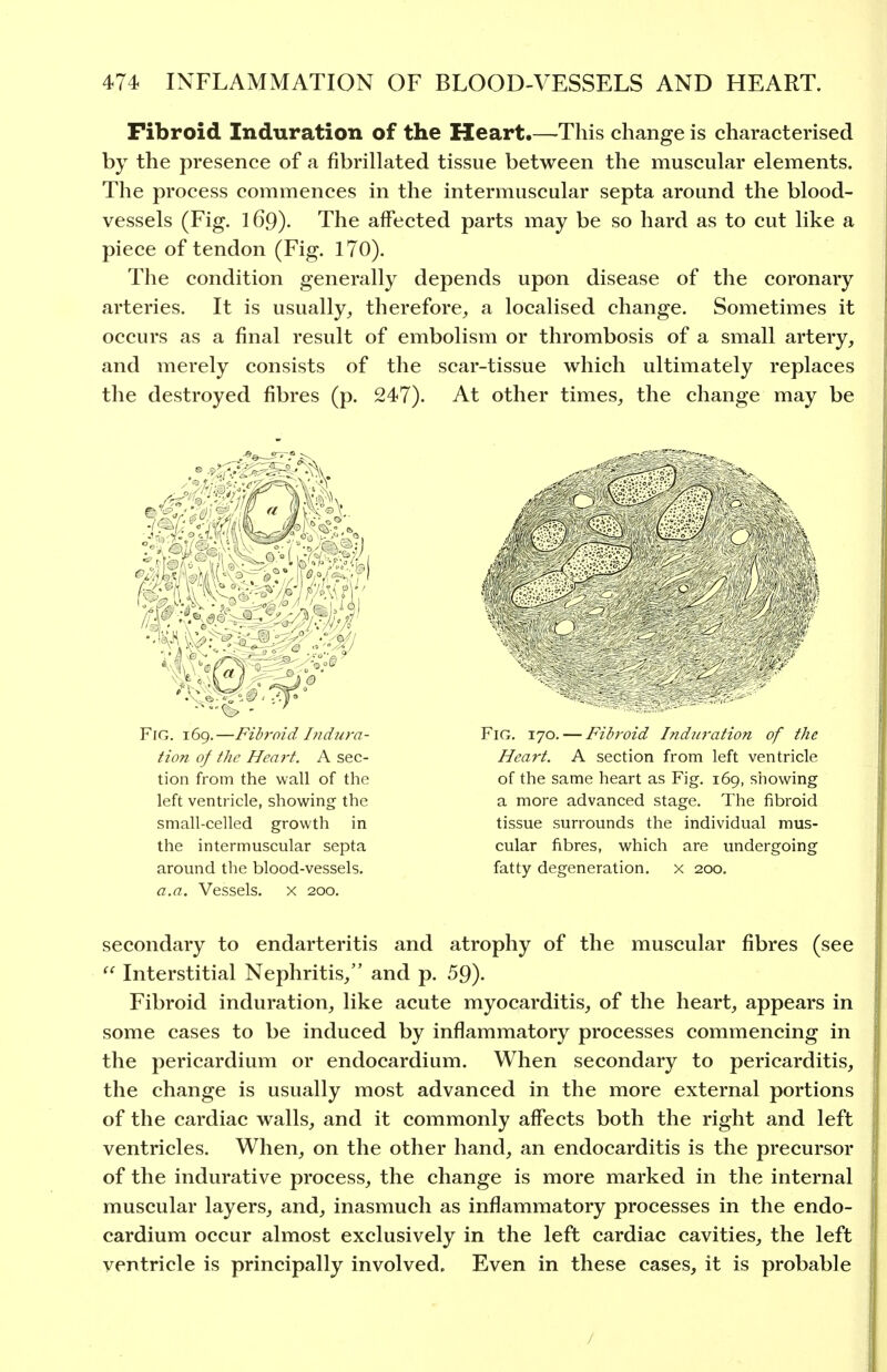 Fibroid Induration of the Heart.—This change is characterised by the presence of a fibrillated tissue between the muscular elements. The process commences in the intermuscular septa around the blood- vessels (Fig. 169). The affected parts may be so hard as to cut like a piece of tendon (Fig. 170). The condition generally depends upon disease of the coronary arteries. It is usually, therefore, a localised change. Sometimes it occurs as a final result of embolism or thrombosis of a small artery, and merely consists of the scar-tissue which ultimately replaces the destroyed fibres (p. 247). At other times, the change may be Fig. 169.—Fibroid I71 dura- tion of the Heart. A sec- tion from the wall of the left ventricle, showing the small-celled growth in the intermuscular septa around the blood-vessels. a.a. Vessels, x 200. Fig. 170. — Fibroid Induration of the Heart. A section from left ventricle of the same heart as Fig. 169, showing a more advanced stage. The fibroid tissue surrounds the individual mus- cular fibres, which are undergoing fatty degeneration, x 200. secondary to endarteritis and atrophy of the muscular fibres (see Interstitial Nephritis, and p. 59). Fibroid induration, like acute myocarditis, of the heart, appears in some cases to be induced by inflammatory processes commencing in the pericardium or endocardium. When secondary to pericarditis, the change is usually most advanced in the more external portions of the cardiac walls, and it commonly affects both the right and left ventricles. When, on the other hand, an endocarditis is the precursor of the indurative process, the change is more marked in the internal muscular layers, and, inasmuch as inflammatory processes in the endo- cardium occur almost exclusively in the left cardiac cavities, the left ventricle is principally involved. Even in these cases, it is probable /